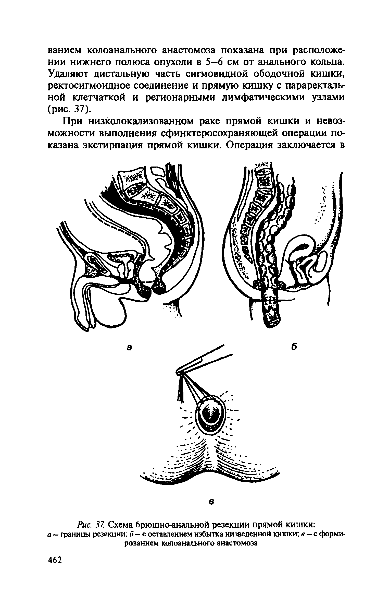Рис. 37. Схема брюшно-анальной резекции прямой кишки а — границы резекции б — с оставлением избытка низведенной кишки в — с формированием колоанального анастомоза...