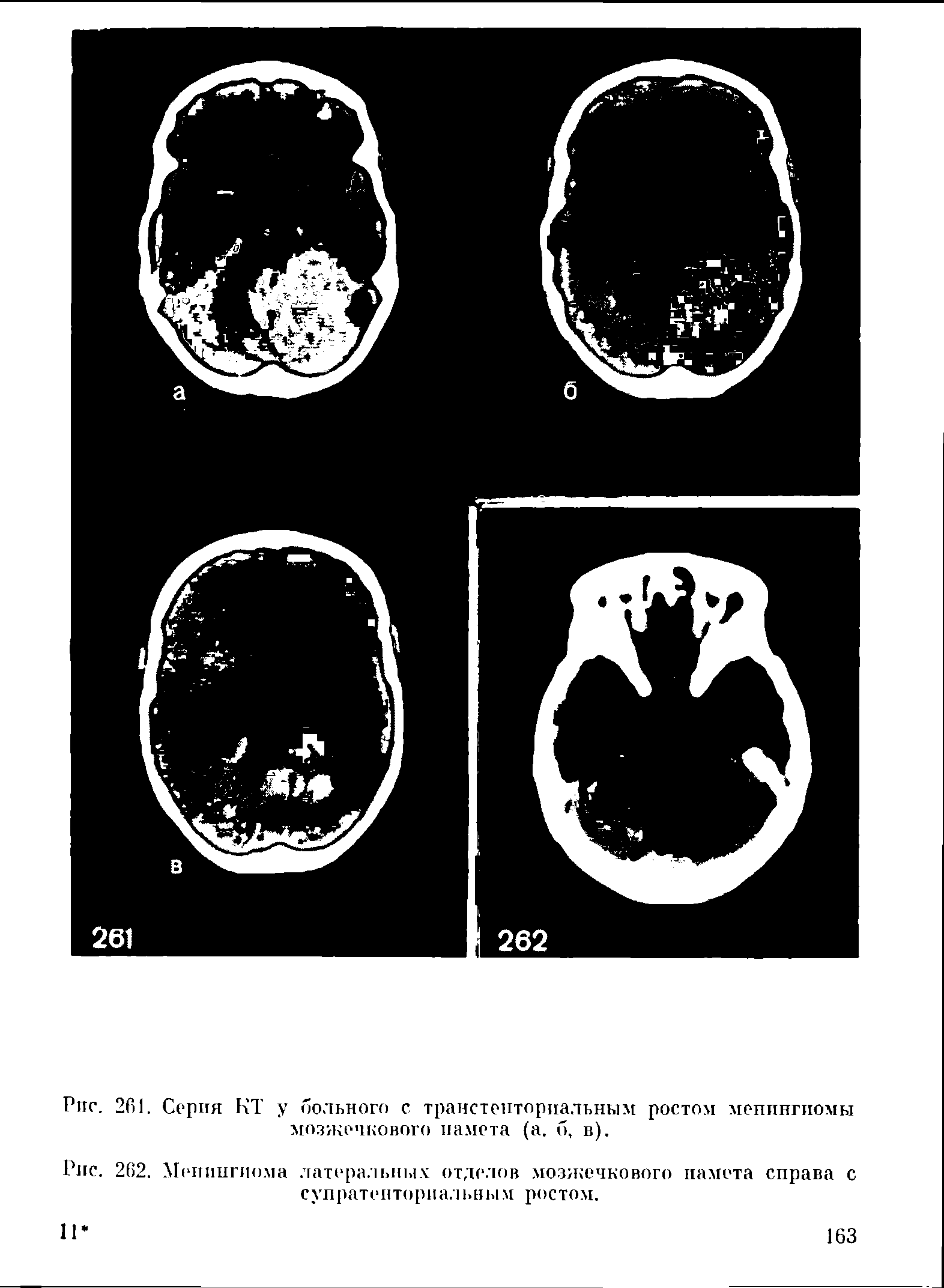 Рис. 262. Менингиома латеральных отделов мозжечкового намета справа с супратенториальным ростом.