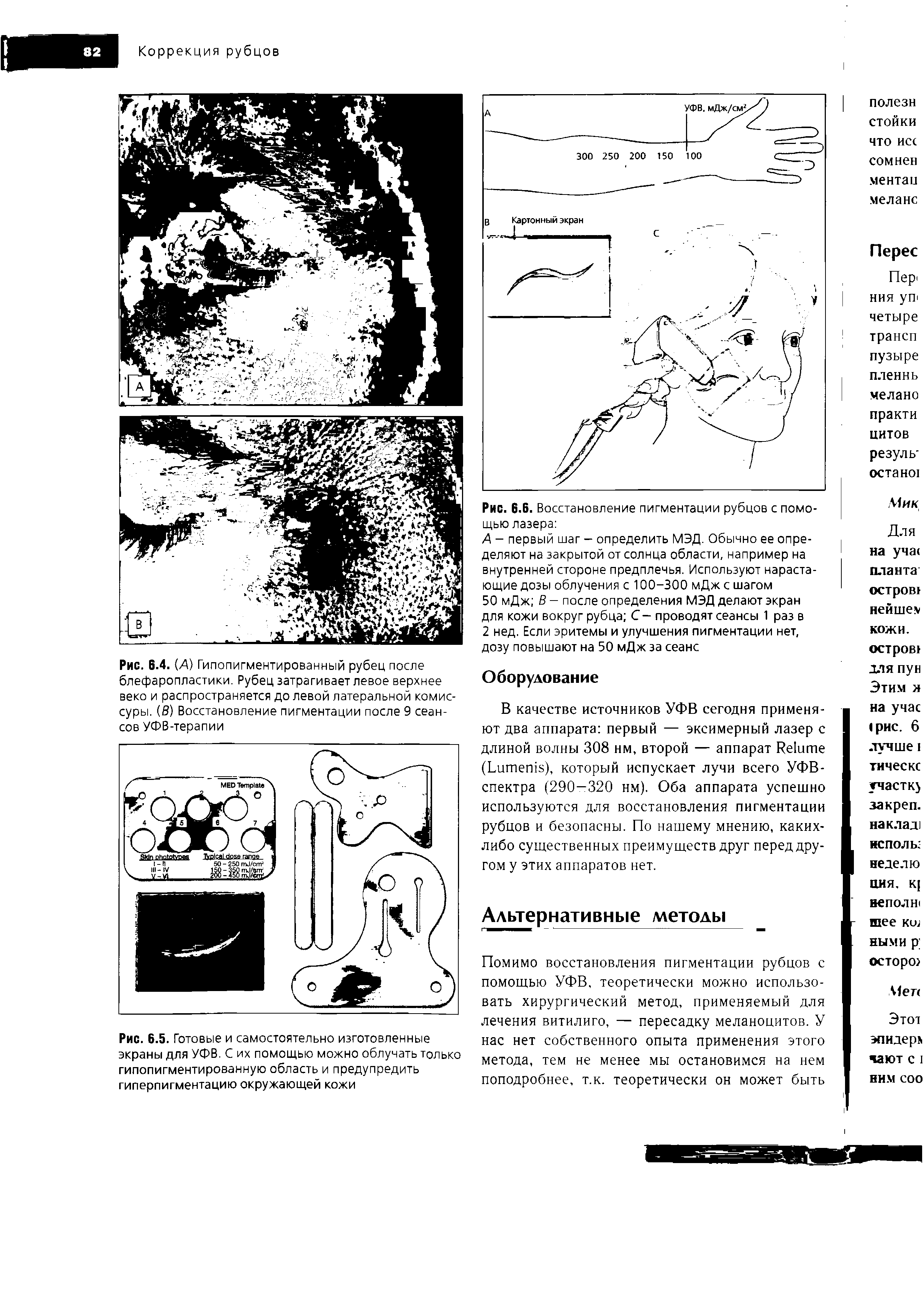 Рис. В.4. (А) Гипопигментированный рубец после блефаропластики. Рубец затрагивает левое верхнее веко и распространяется до левой латеральной комиссуры. (б) Восстановление пигментации после 9 сеансов УФВ-терапии...