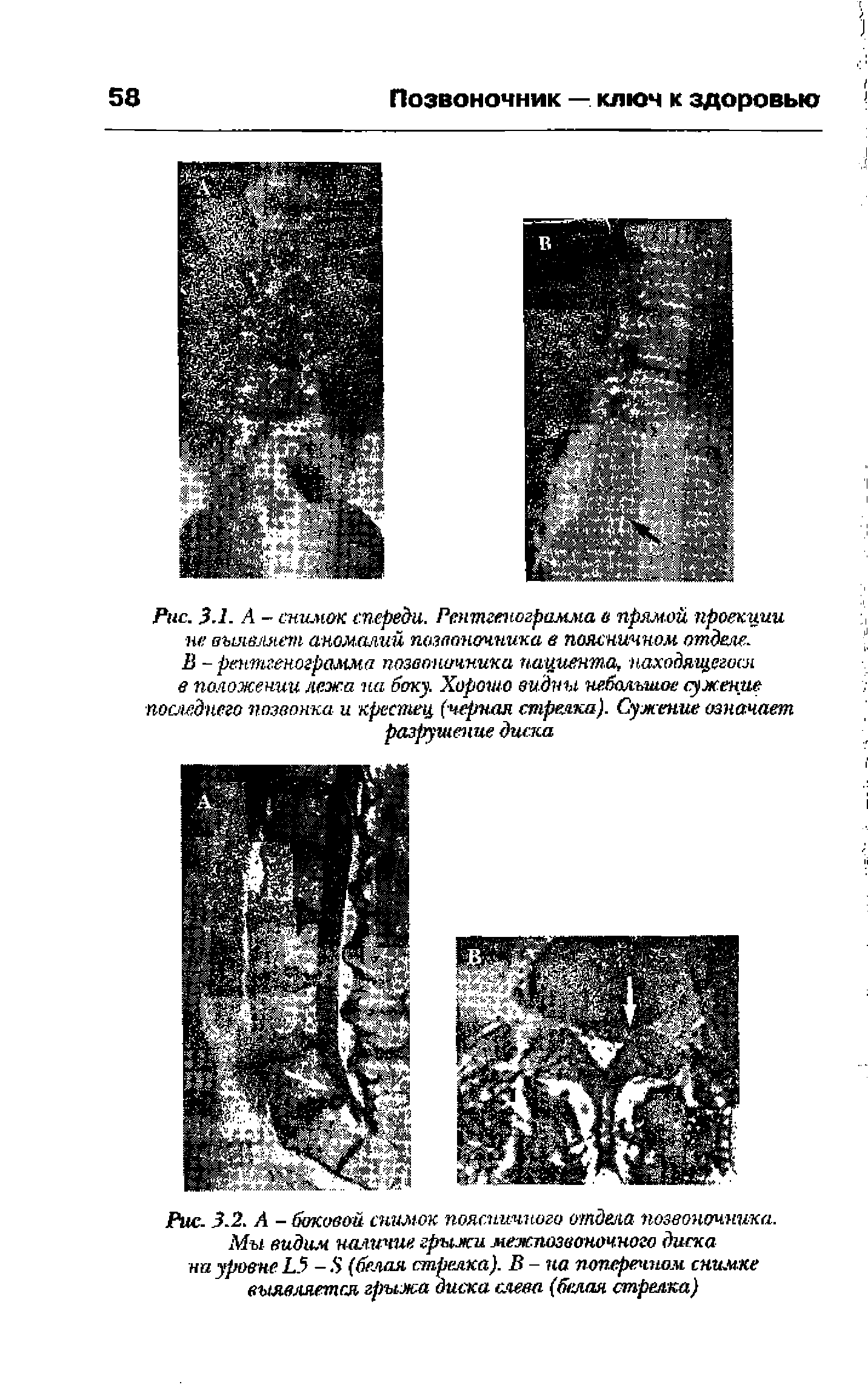 Рис. 3.2. А - боковой снимок поясничного отдела позвоночника. Мы- видим наличие грыжи межпозвоночного диска на уровне 1.5 -8 (белая стрелка). В - на поперечном снимке выявляется грыжа диска слева (белая стрелка)...