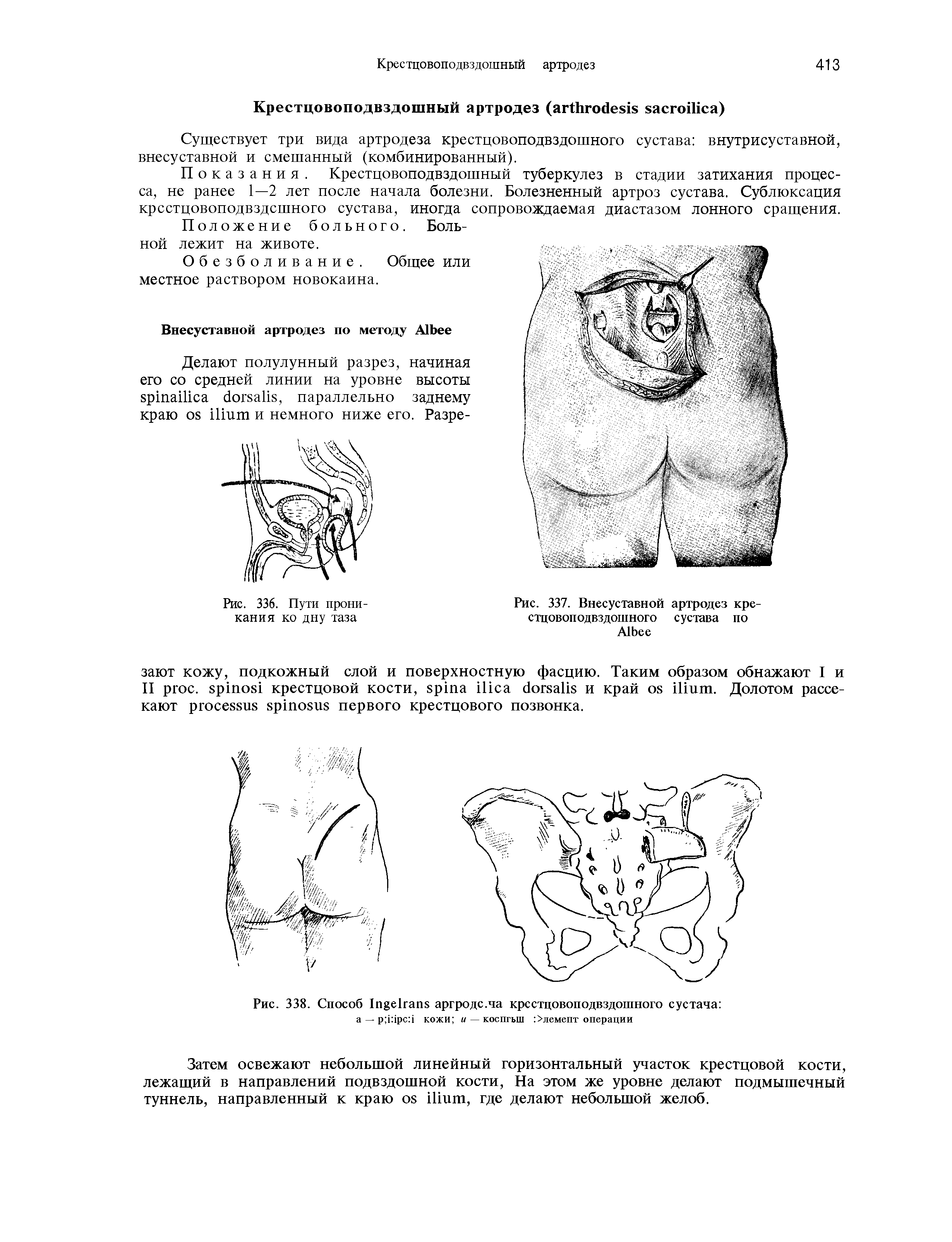 Рис. 336. Пути прони- кания ко дну таза Рис. 337. Внесуставной артродез крестцовоподвздошного сустава по A ...