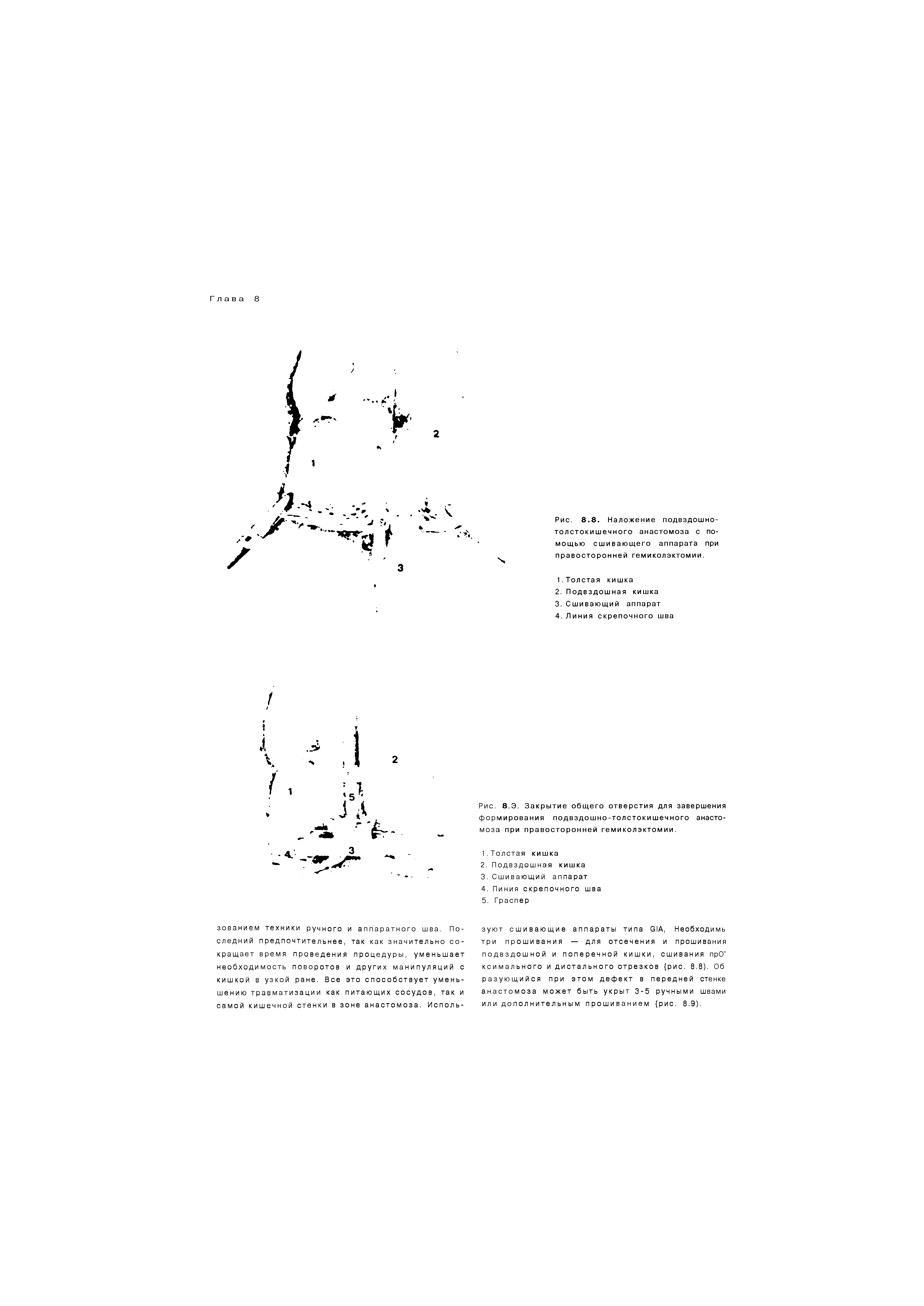 Рис. 8.Э. Закрытие общего отверстия для завершения формирования подвздошно-толстокишечного анастомоза при правосторонней гемиколэктомии.