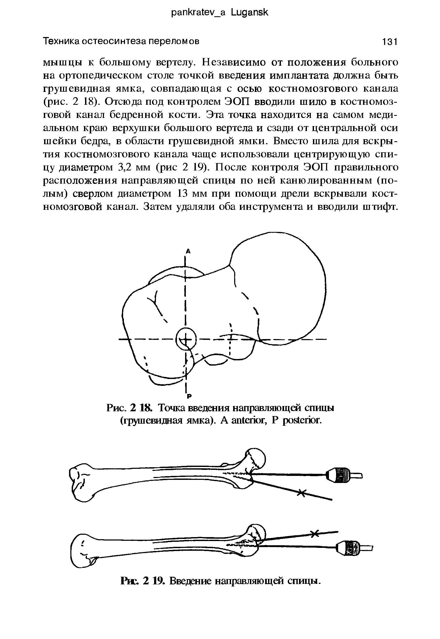 Рис. 2 18. Точка введения направляющей спицы (грушевидная ямка). A , Р .