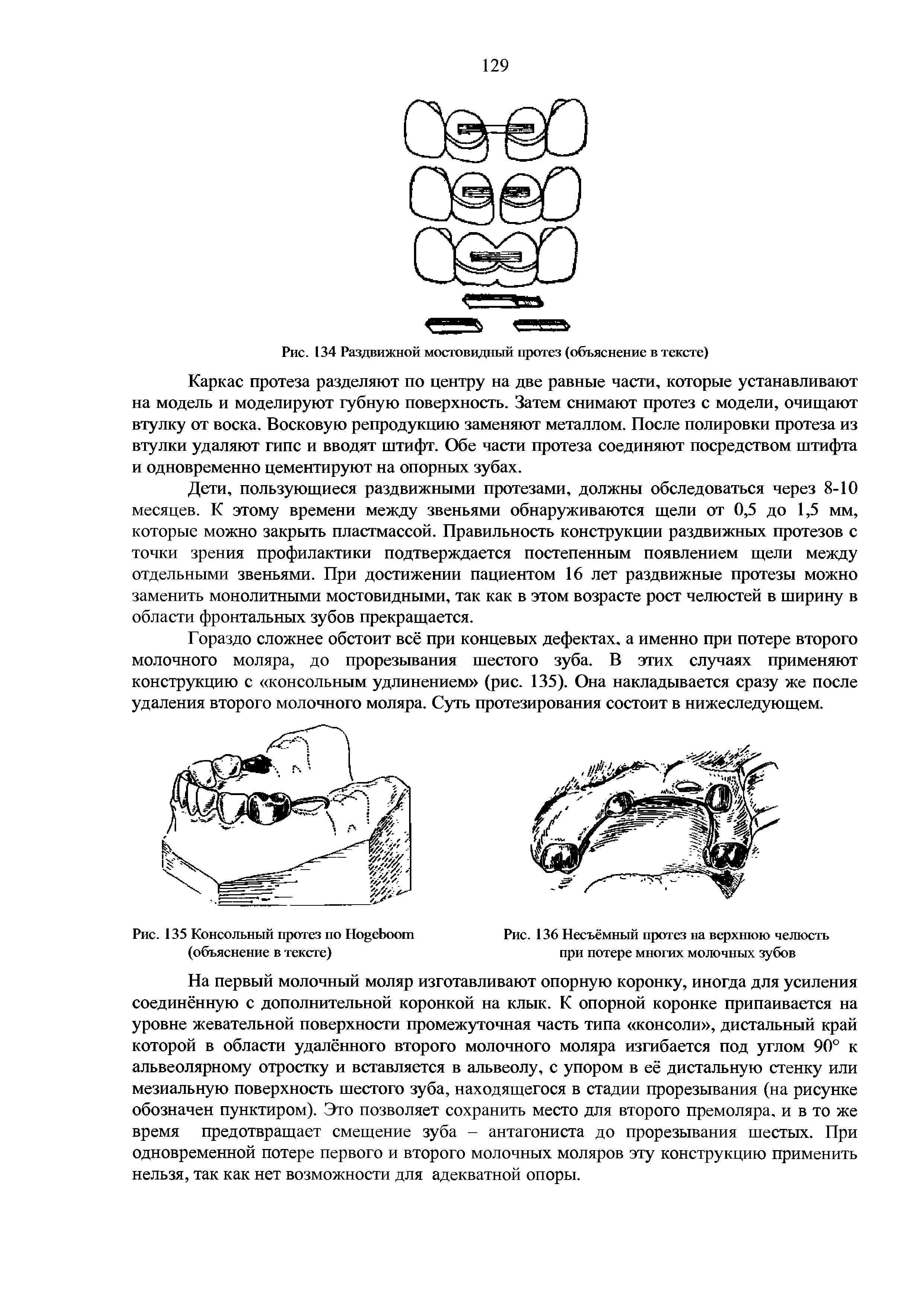 Рис. 135 Консольный протез по Но еЬоот Рис. 136 Несъёмный протез на верхнюю челюсть...