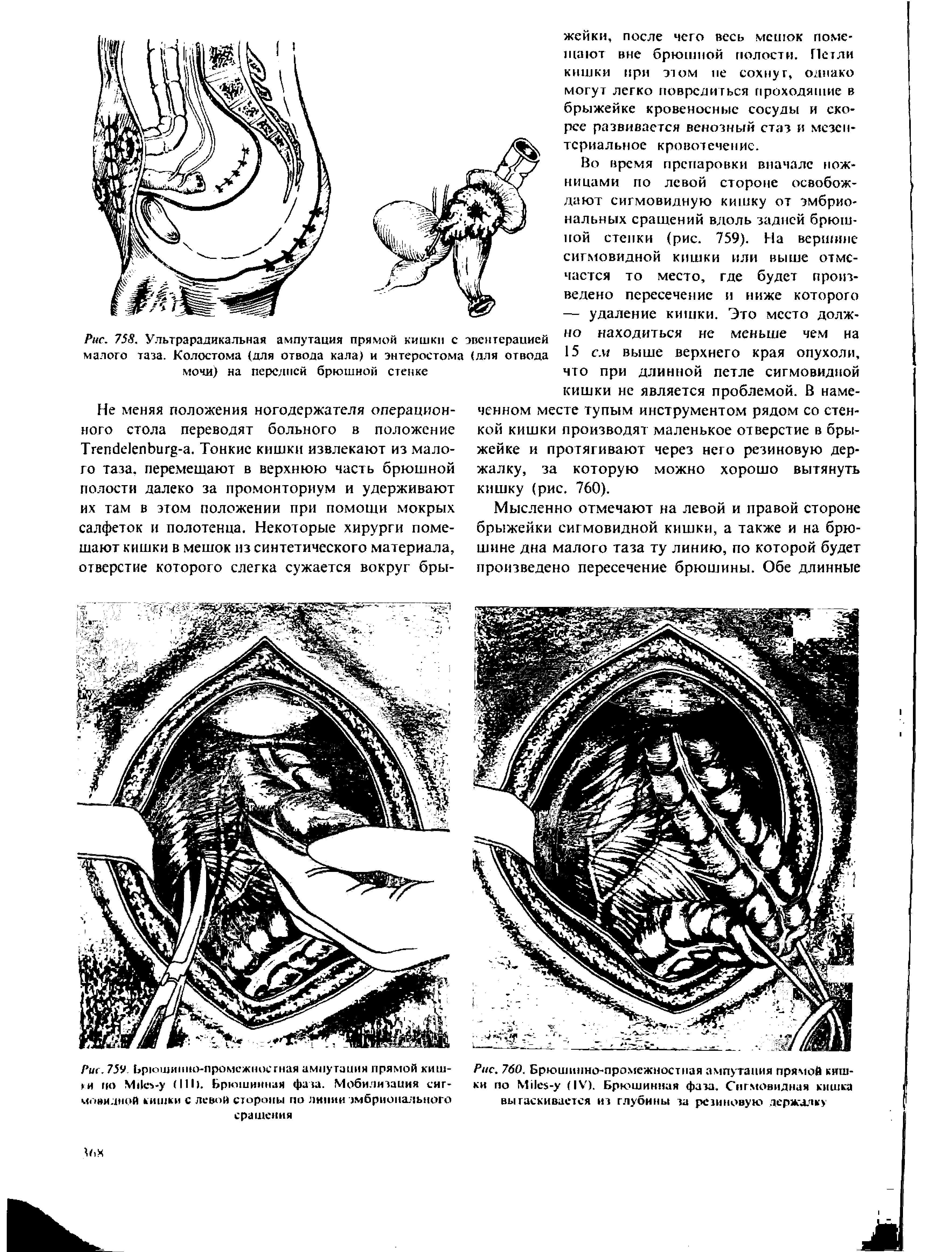 Рис. 760. Брюшинно-промежностная ампутация прямой кишки по МИс -у (IV). Брюшинная фаза. Сигмовидная кишка вытаскивается из глубины за резиновую держалку...