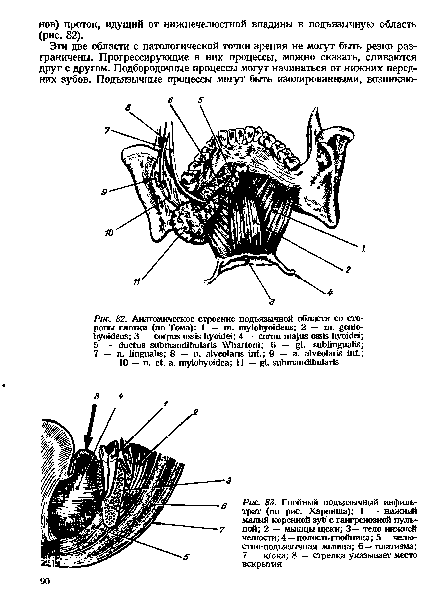 Рис. 83. Гнойный подъязычный инфильтрат (по рис. Харниша) 1 — нижний малый коренной зуб с гангренозной пуль пой 2 — мышцы щеки 3— тело нижней челюсти 4 — полость гнойника 5 — челюстно-подъязычная мышца 6—платизма 7 — кожа 8 — стрелка указывает место вскрытия...