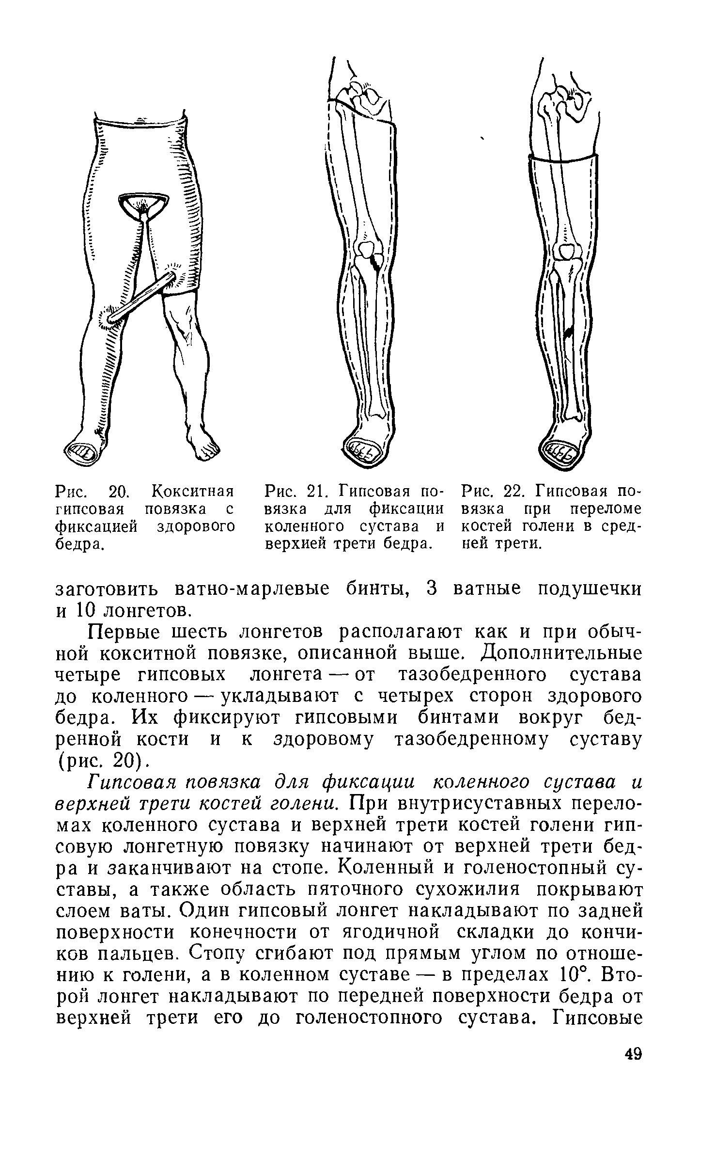 Рис. 22. Гипсовая повязка при переломе костей голени в средней трети.