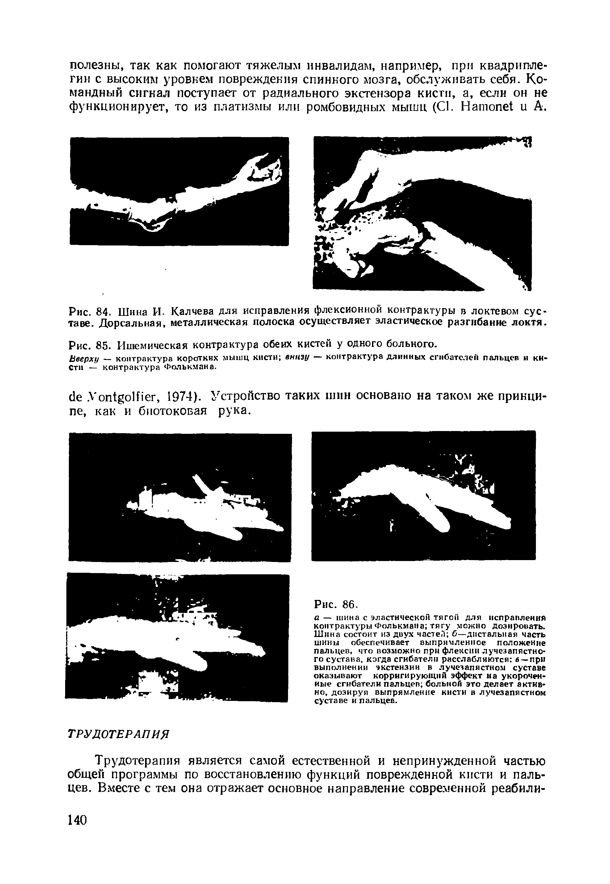 Рис. 85. Ишемическая контрактура обеих кистей у одного больного.