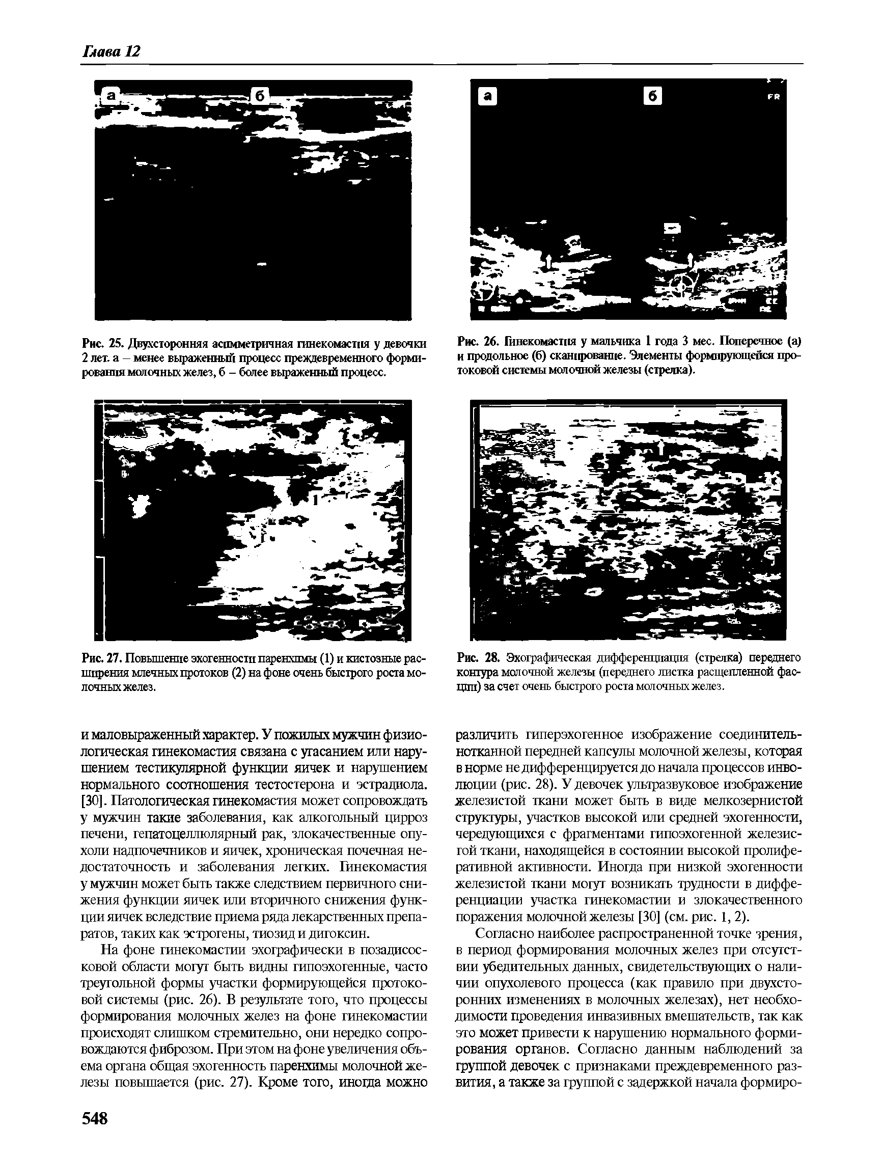 Рис. 25. Двухсторонняя асимметричная гинекомастия у девочки 2 лет. а - менее выраженный процесс преждевременного формирования молочных желез, б - более выраженный процесс.