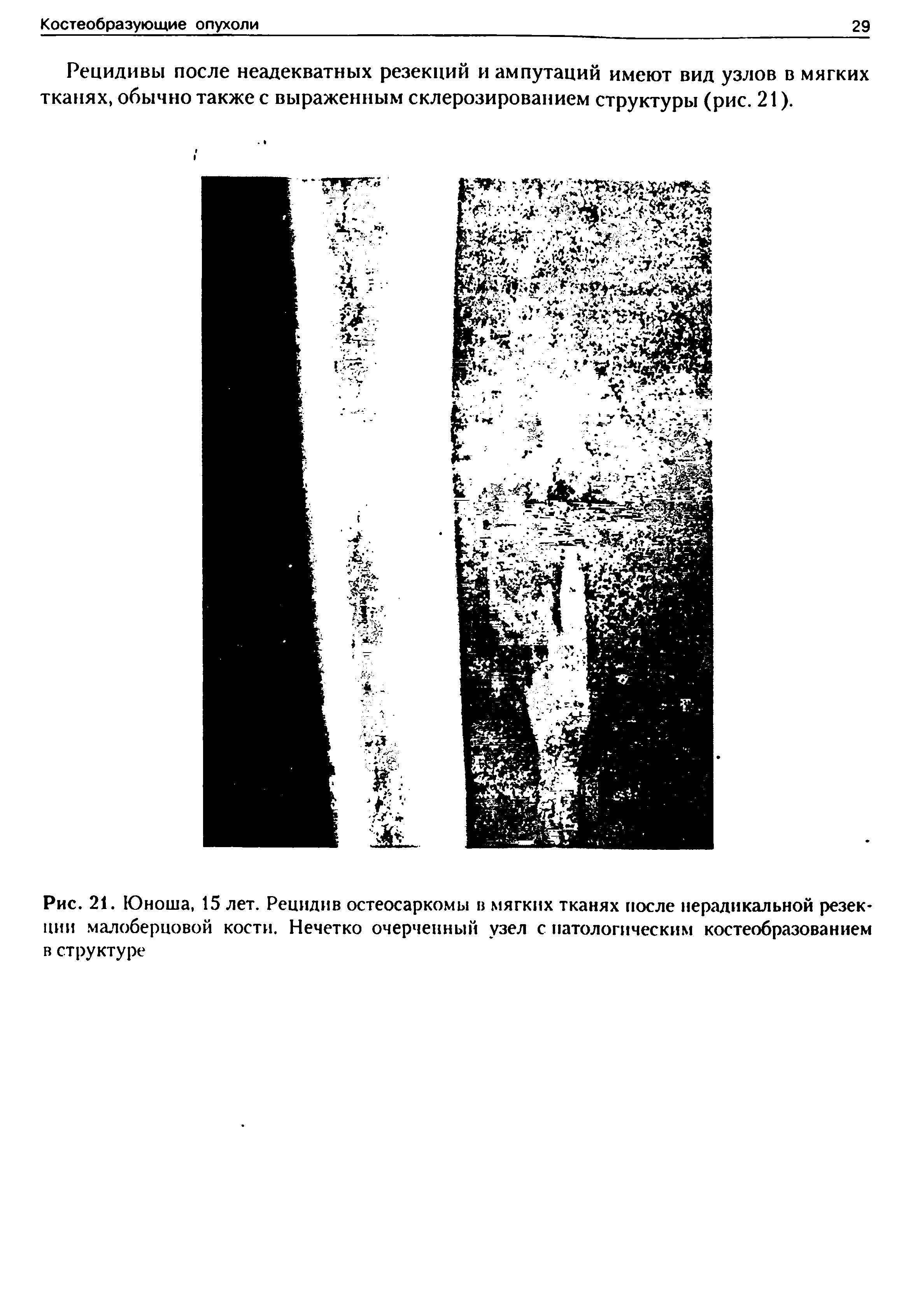 Рис. 21. Юноша, 15 лет. Рецидив остеосаркомы в мягких тканях после нерадикальной резекции малоберцовой кости. Нечетко очерченный узел с патологическим костеобразованием в структуре...