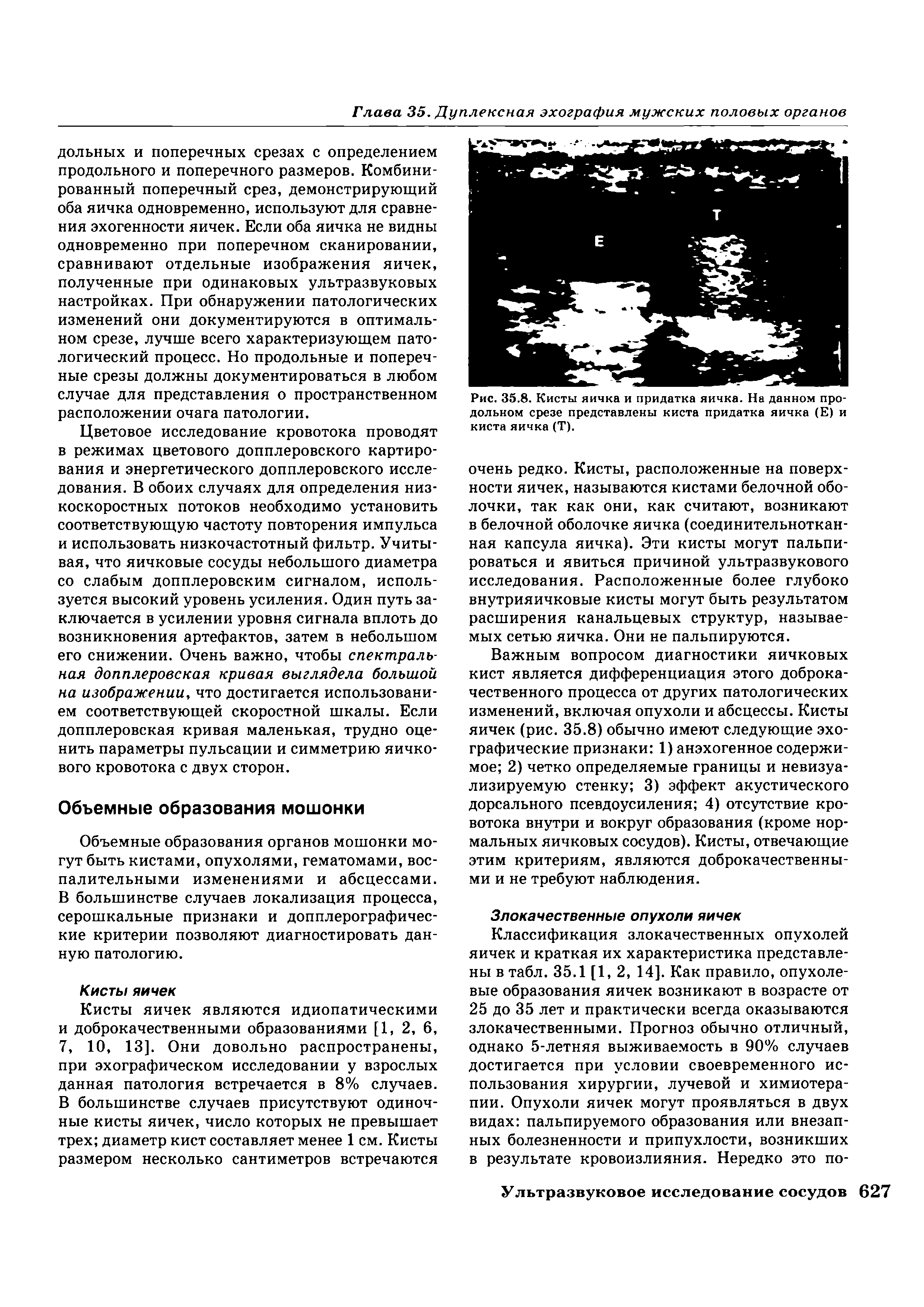 Рис. 35.8. Кисты яичка и придатка яичка. На данном продольном срезе представлены киста придатка яичка (Е) и киста яичка (Т).