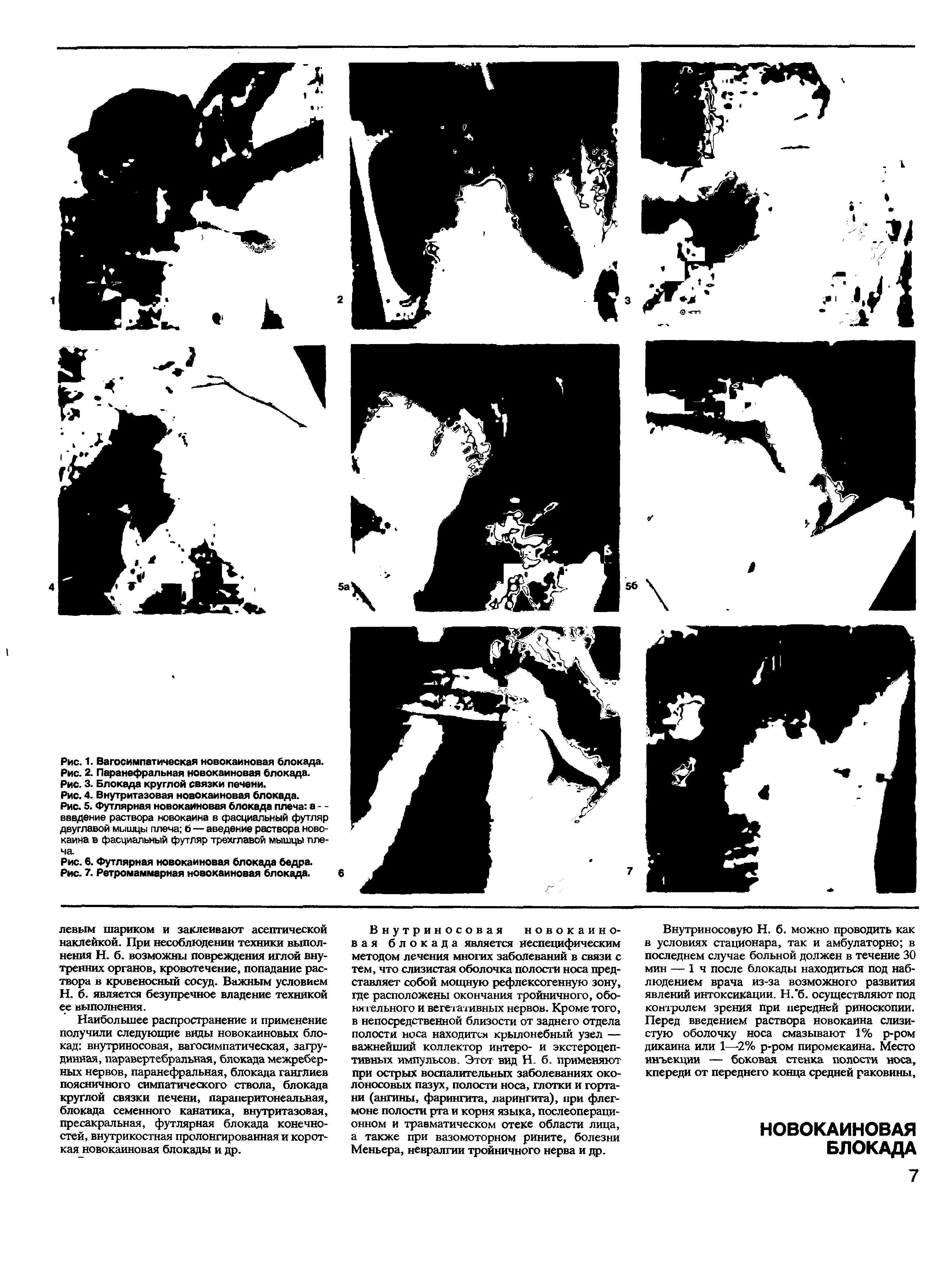 Рис. 6. Футлярная новокаиновая блокада бедра. Рис. 7. Ретромаммарная новокаиновая блокада.