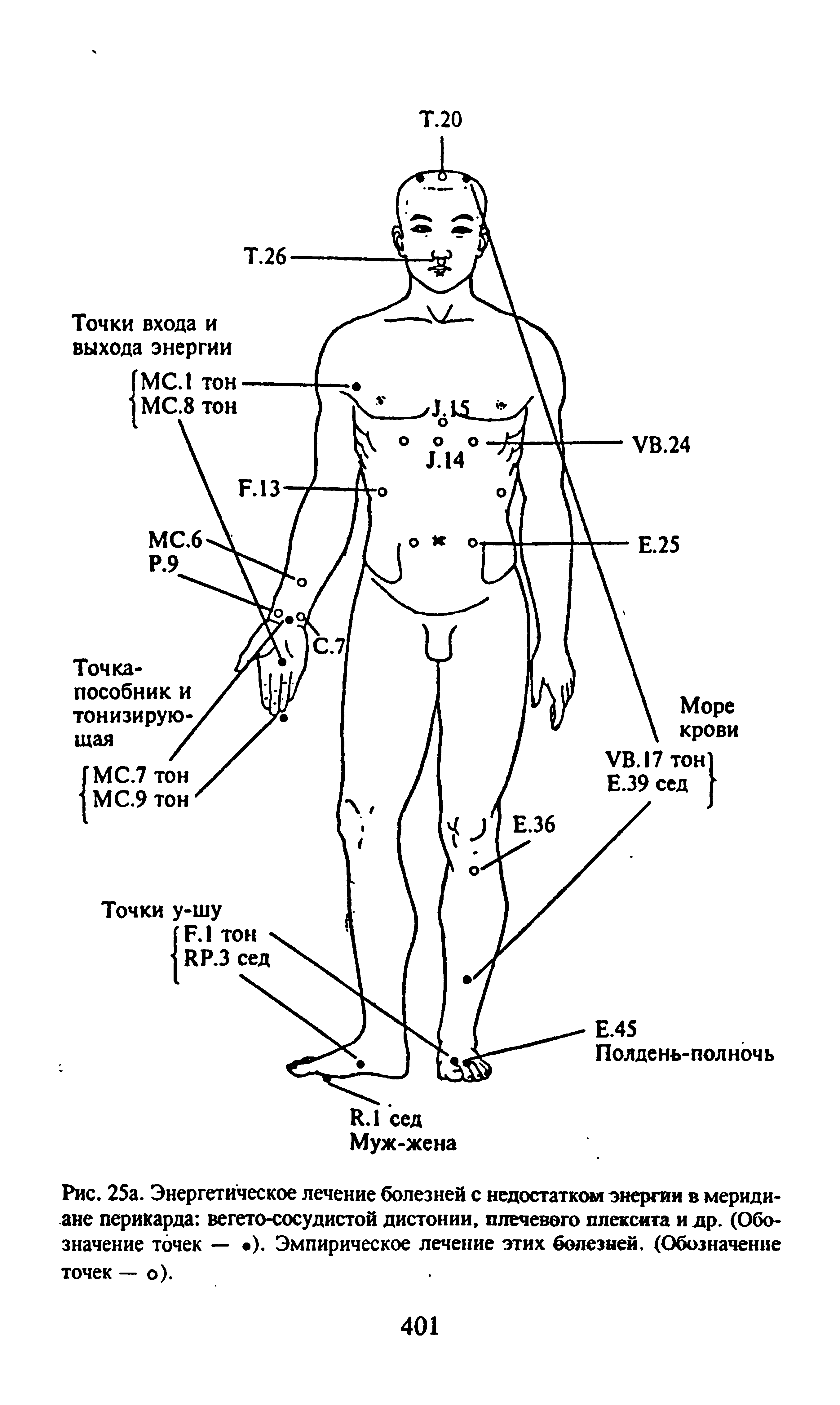 Рис. 25а. Энергетическое лечение болезней с недостатком энергии в меридиане перикарда вегето-сосудистой дистонии, плечевого плексита и др. (Обозначение точек — ). Эмпирическое лечение этих болезней. (Обозначение точек — о).