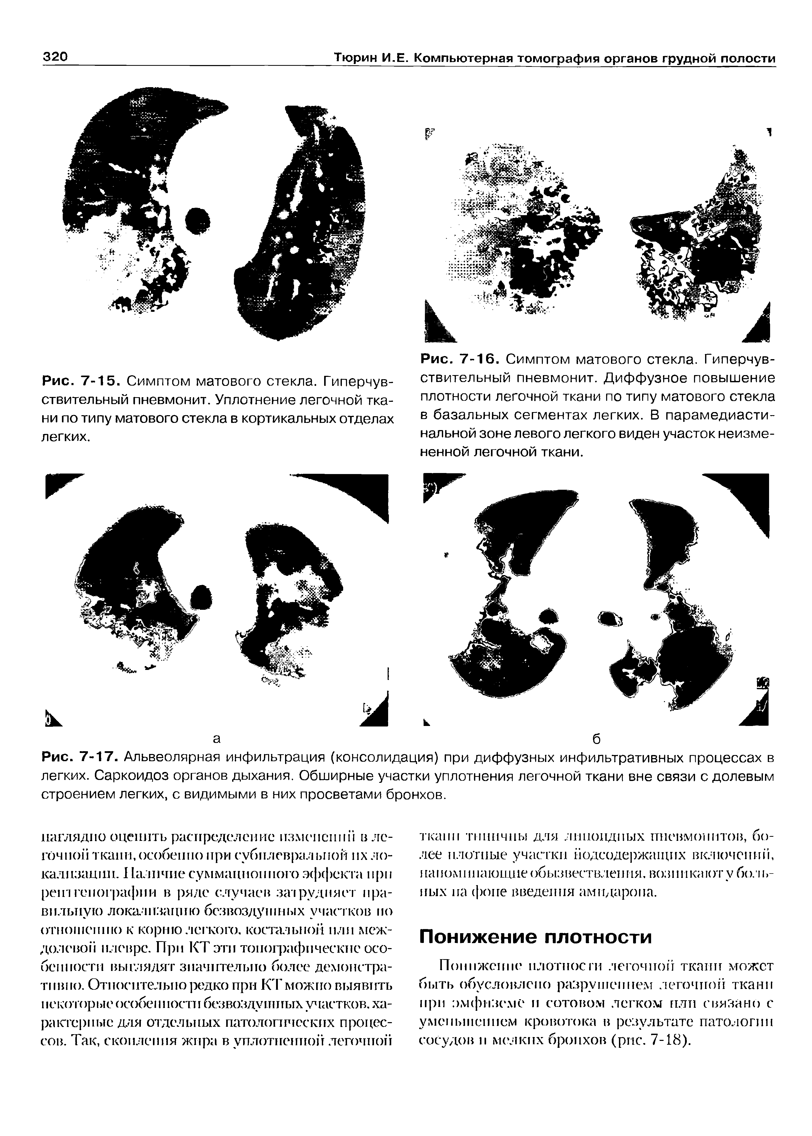 Рис. 7-17. Альвеолярная инфильтрация (консолидация) при диффузных инфильтративных процессах в легких. Саркоидоз органов дыхания. Обширные участки уплотнения легочной ткани вне связи с долевым строением легких, с видимыми в них просветами бронхов.