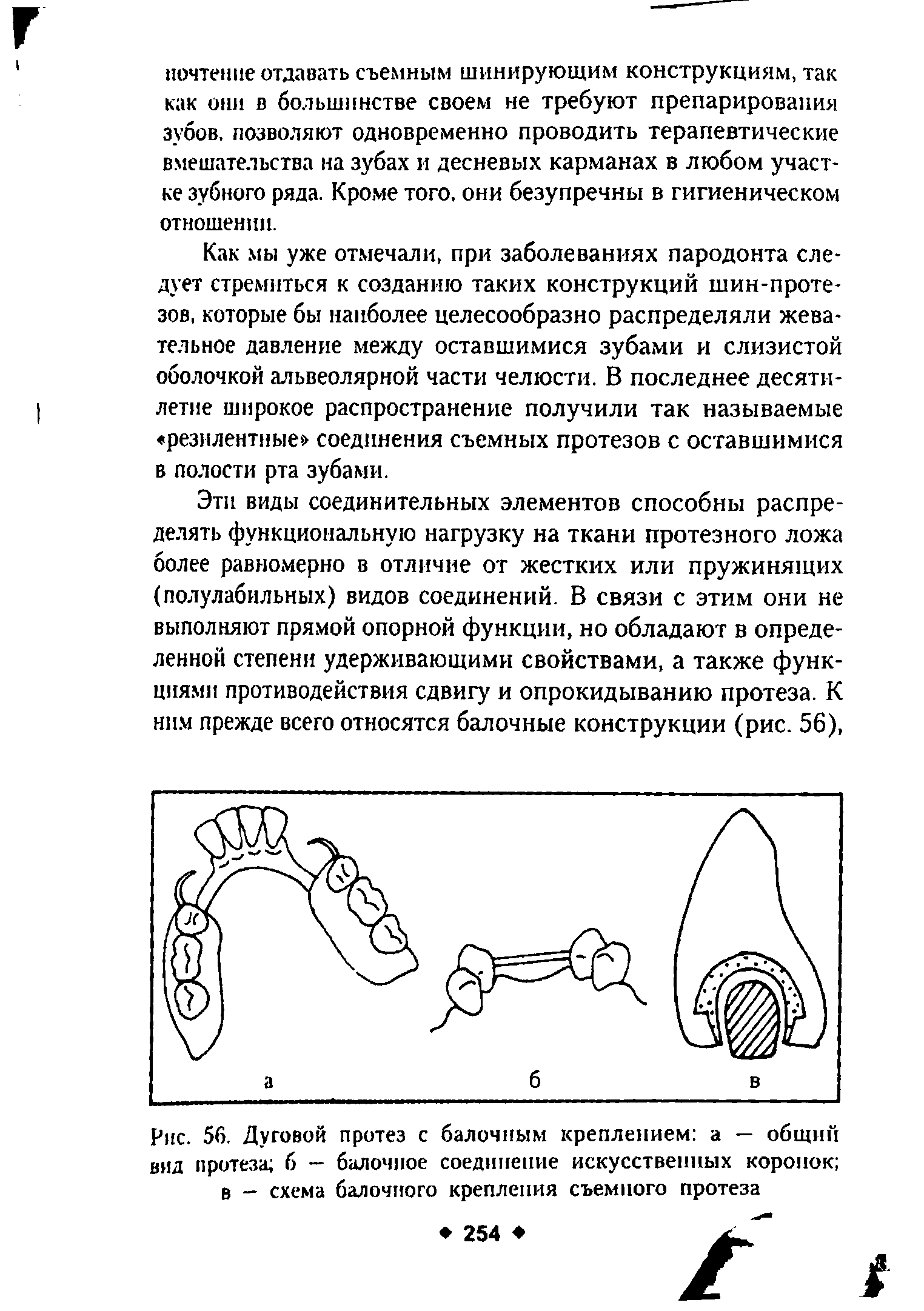 Рис. 56. Дуговой протез с балочным креплением а — общий вид протеза б — балочное соединение искусственных коронок в - схема балочного крепления съемного протеза...