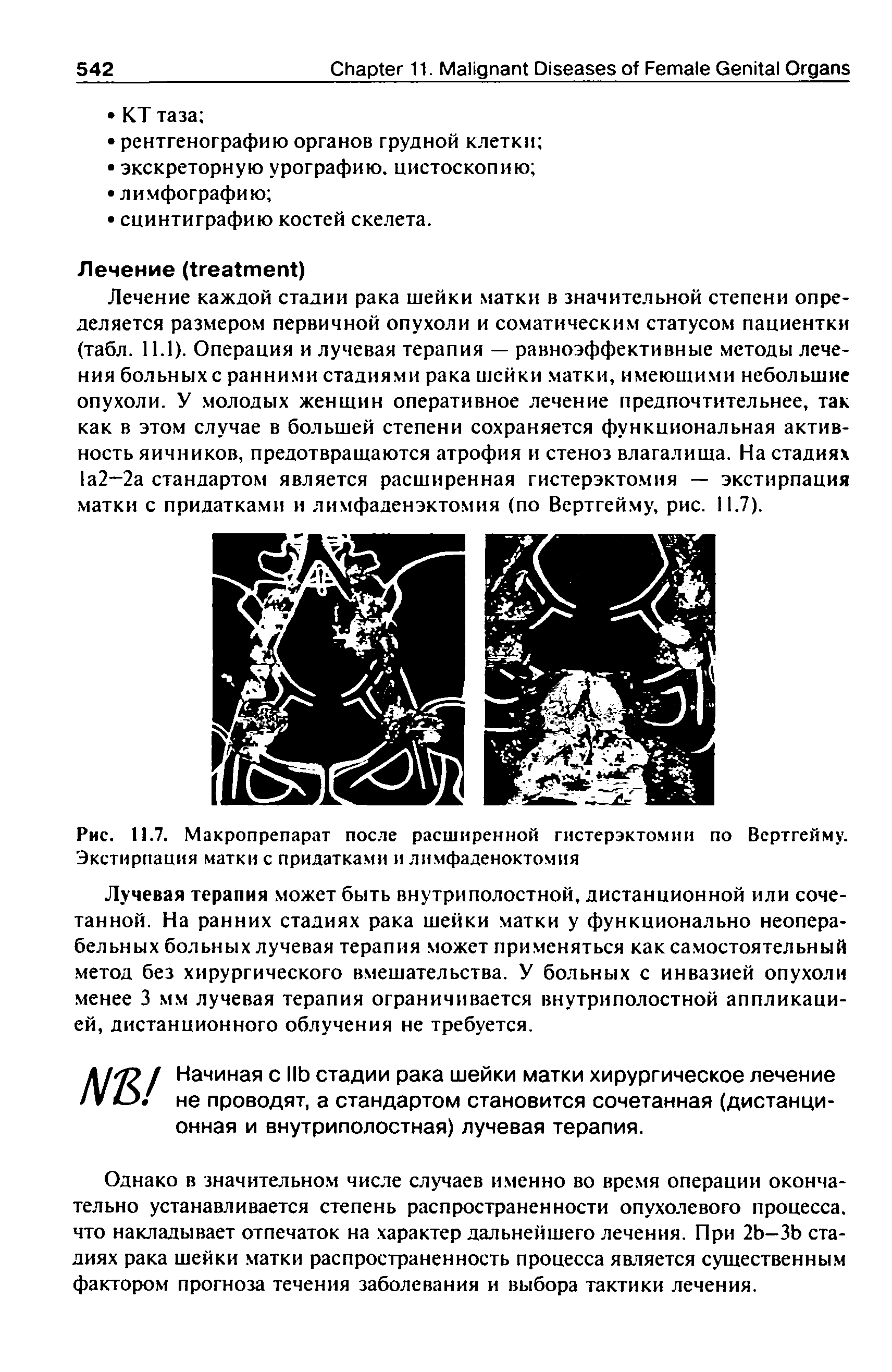 Рис. 11.7. Макропрепарат после расширенной гистерэктомии по Вертгейму. Экстирпация матки с придатками и лимфаденоктомия...