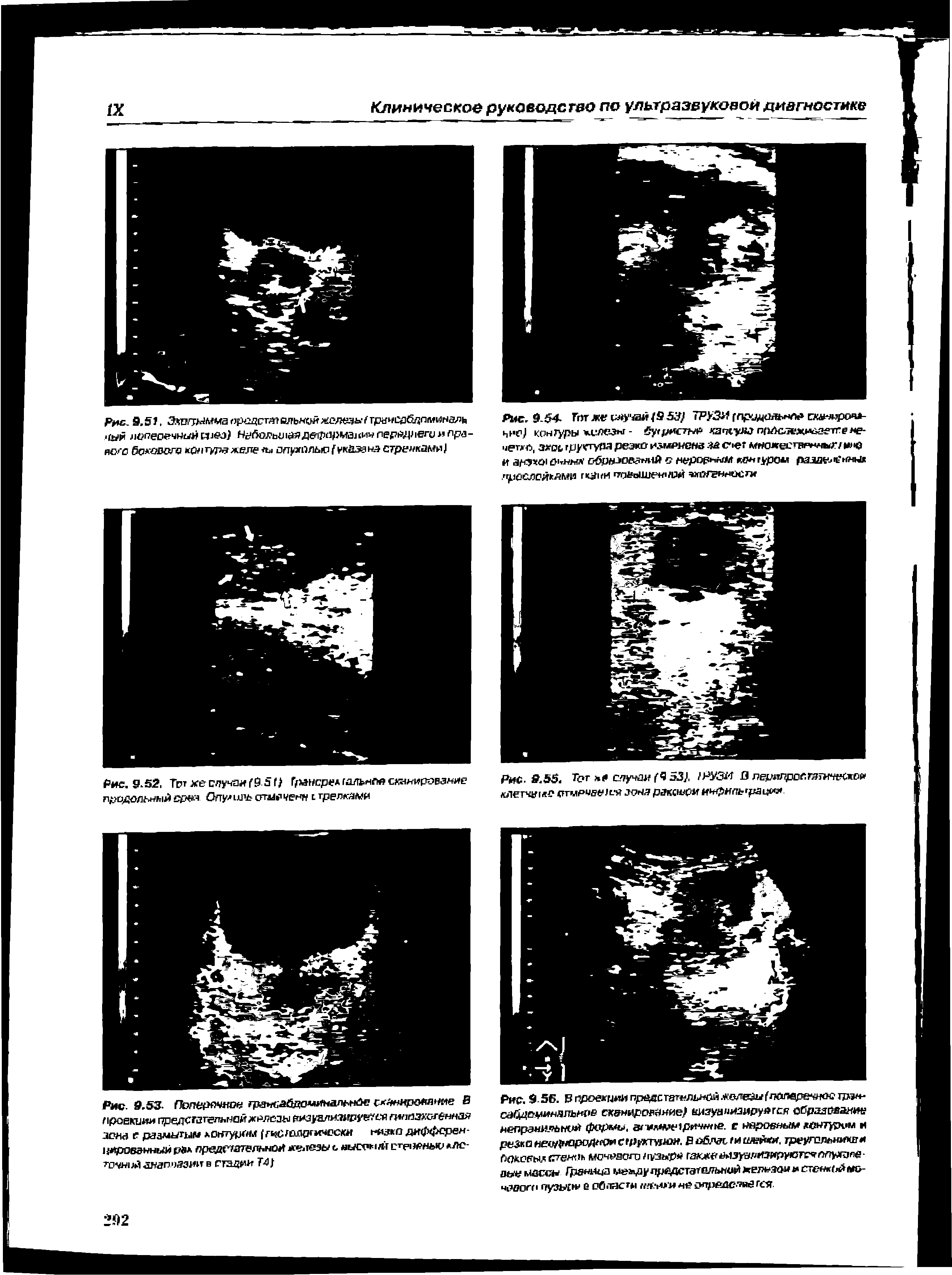 Рис. 9 64- Тот тке мучай (9 53/ 7РУЗИ слрццогя-нле омммроч -чнс) контуры железы - бугристы кзисука прДыежилаетле не-иегхр, зхрь гдуктугм резко изменена за счет мно геетврнлытм >< и а№к<и р1тнмк обрнэований с неровным кон гуром радде нны . грослойкями г е 1гм повышен той зкогвннос ли...