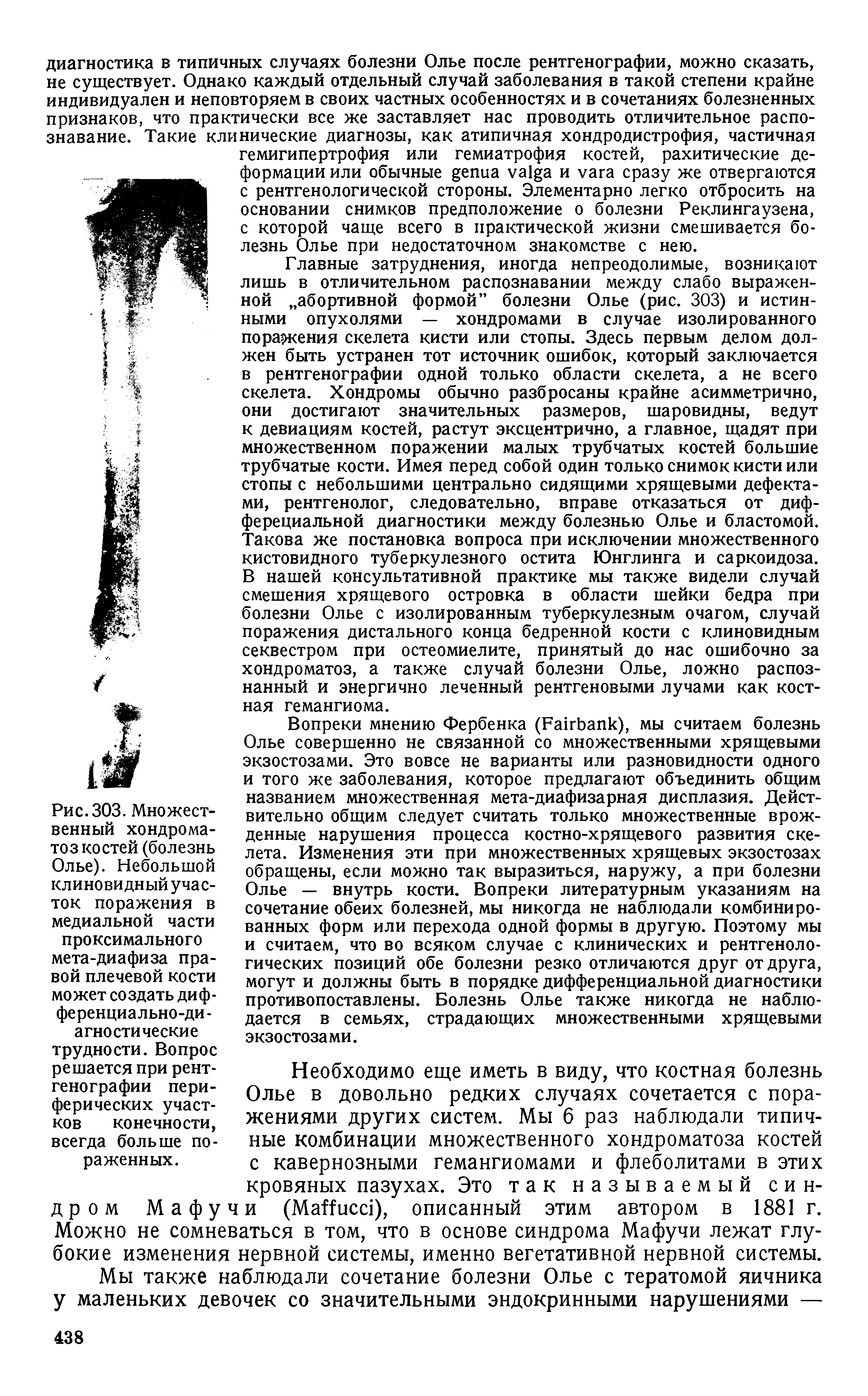 Рис. 303. Множественный хондрома-тоз костей (болезнь Олье). Небольшой клиновидный участок поражения в медиальной части проксимального мета-диафиза правой плечевой кости может создать дифферента льно-ди -агностические трудности. Вопрос решается при рентгенографии периферических участков конечности, всегда больше пораженных.