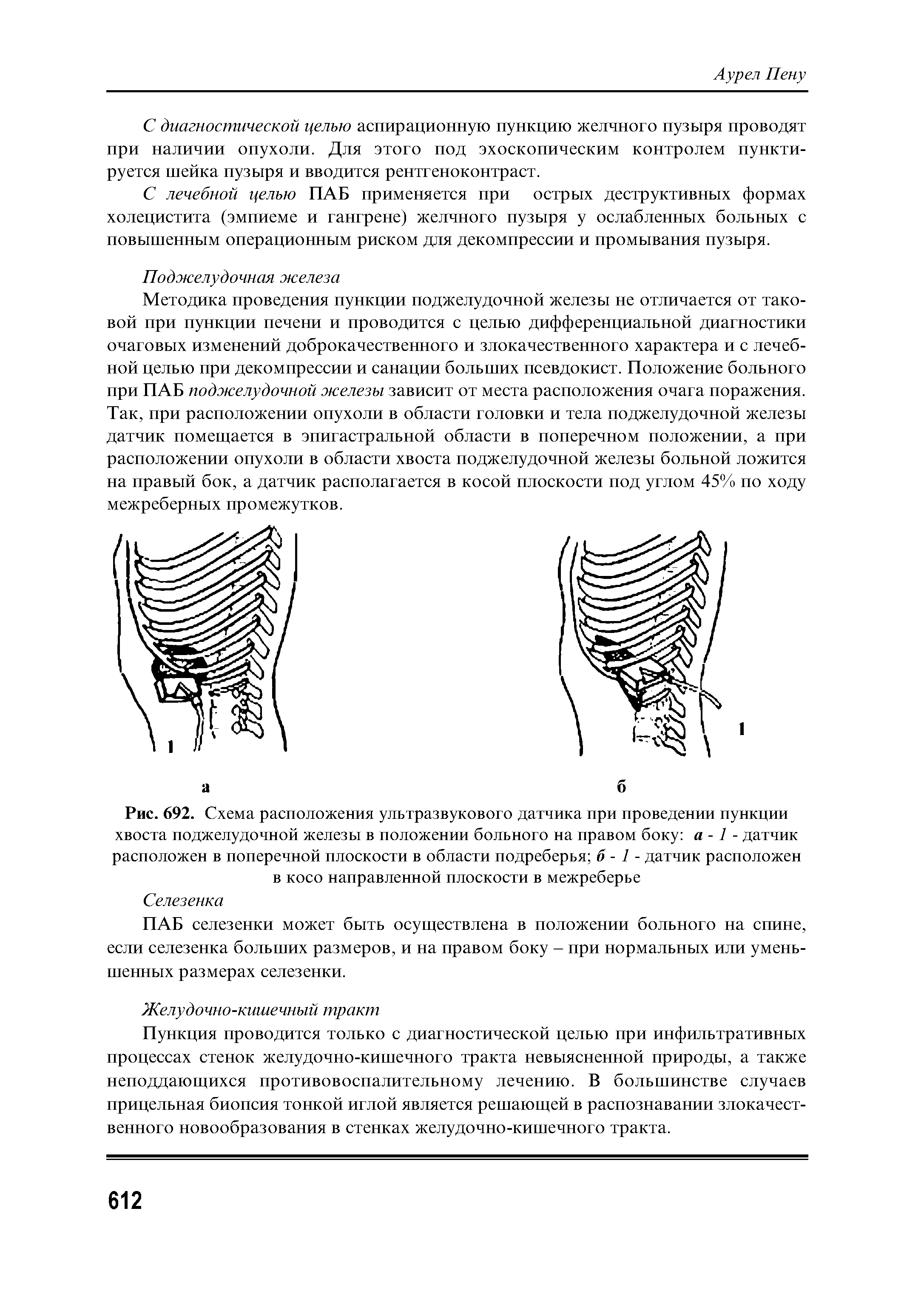 Рис. 692. Схема расположения ультразвукового датчика при проведении пункции хвоста поджелудочной железы в положении больного на правом боку а -1 - датчик расположен в поперечной плоскости в области подреберья б - 1 - датчик расположен в косо направленной плоскости в межреберье...
