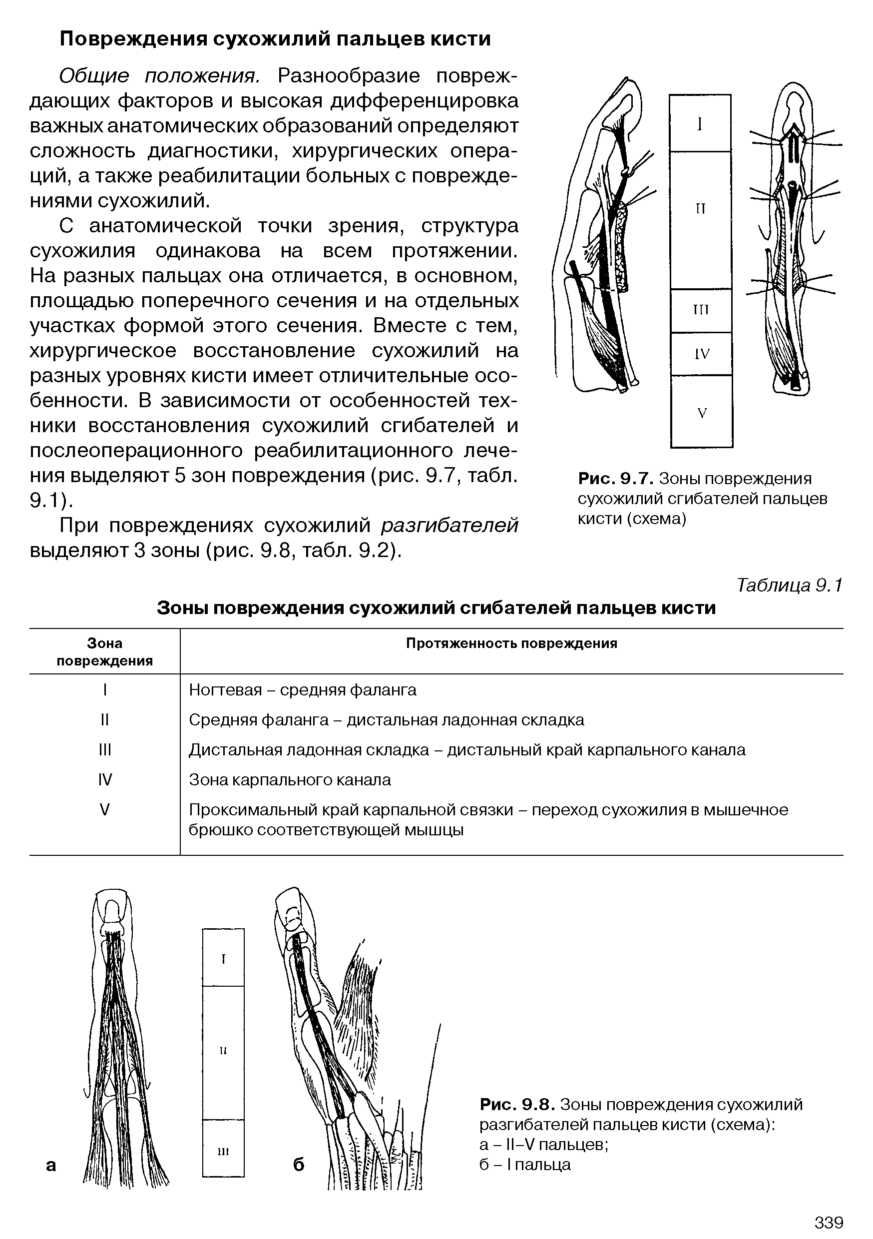 Рис. 9.8. Зоны повреждения сухожилий разгибателей пальцев кисти (схема) а - II—V пальцев ...