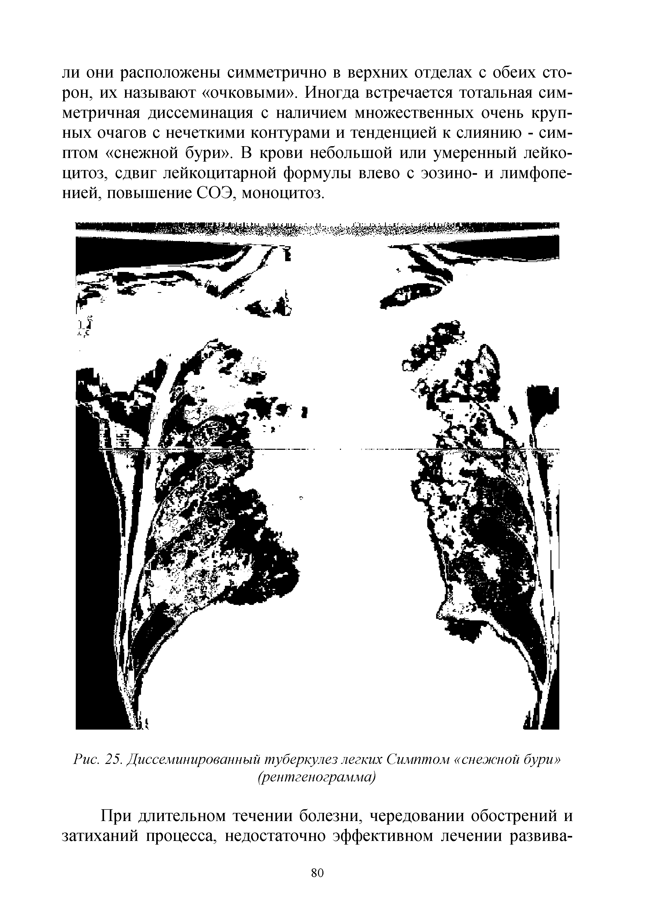 Рис. 25. Диссеминированный туберкулез легких Симптом снежной бури (рентгенограмма)...