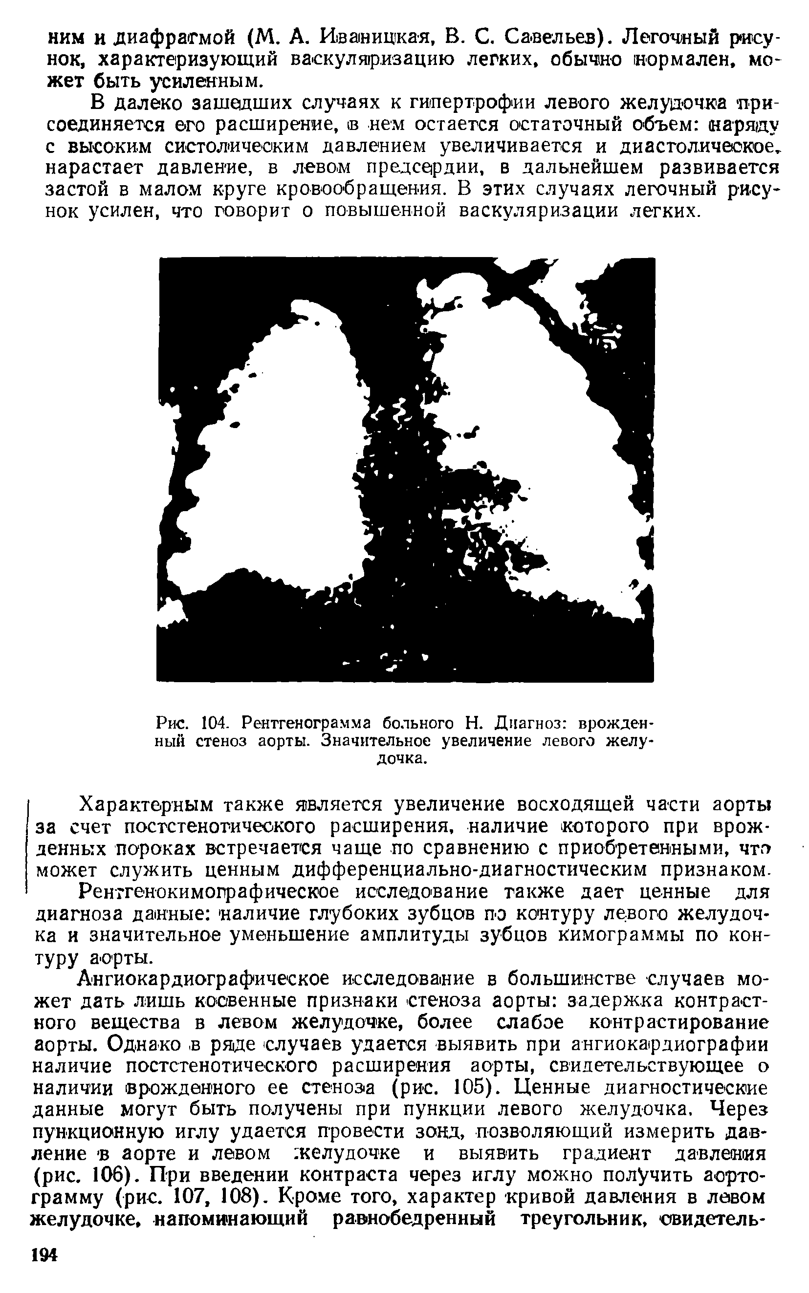 Рис. 104. Рентгенограмма больного Н. Диагноз врожденный стеноз аорты. Значительное увеличение левого желудочка.