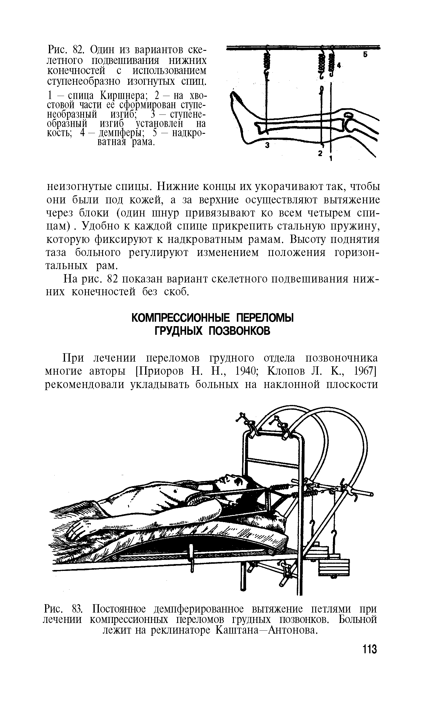 Рис. 83. Постоянное демпферированное вытяжение петлями при лечении компрессионных переломов грудных позвонков. Больной лежит на реклинаторе Каштана—Антонова.