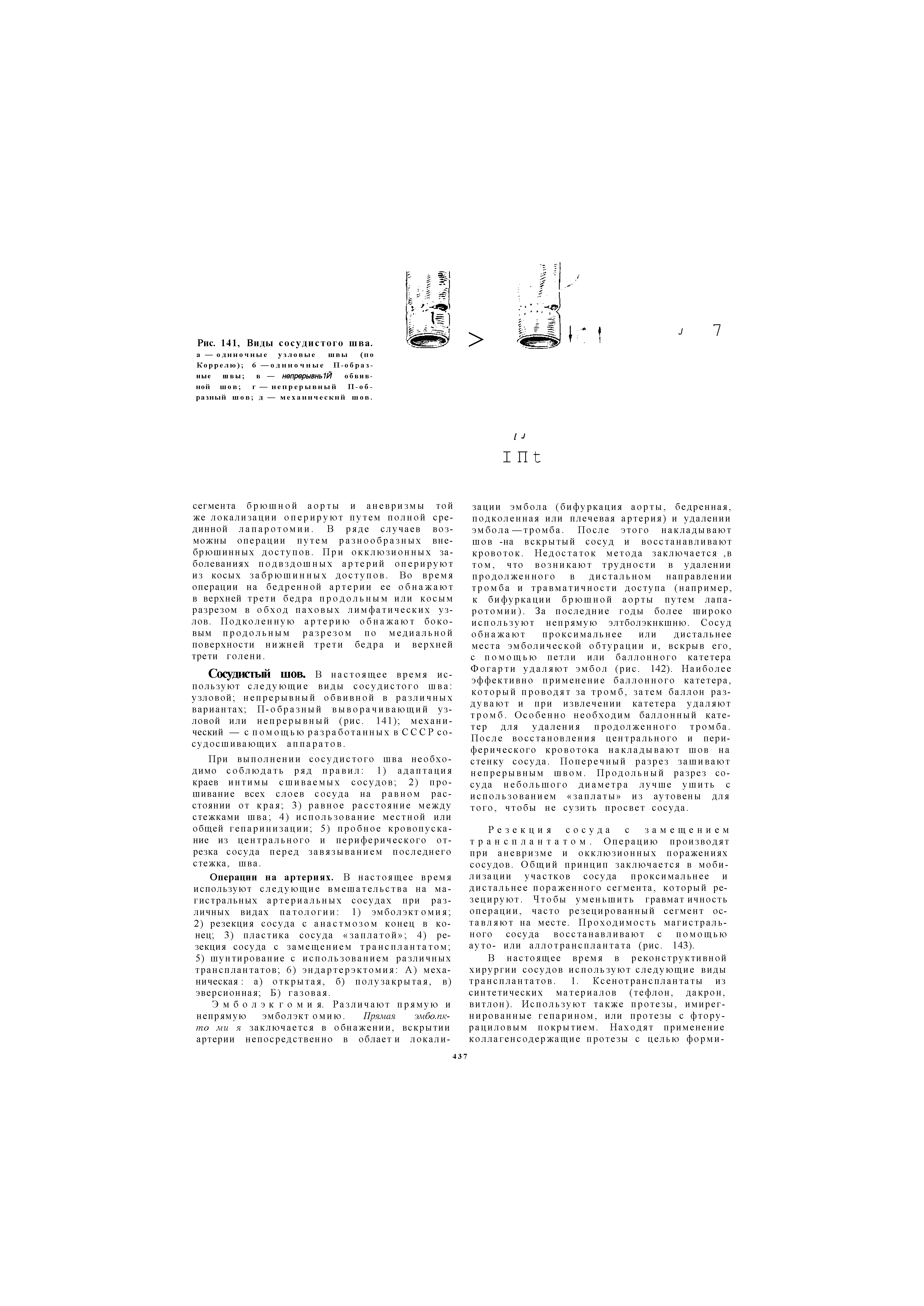 Рис. 141, Виды сосудистого шва. а — одиночные узловые швы (по Коррелю) 6 —одиночные П-образ-н ы е швы в — непрерывНЬ 1Й обвивной шов г — непрерывный П-об-разный шов д — механический шов.