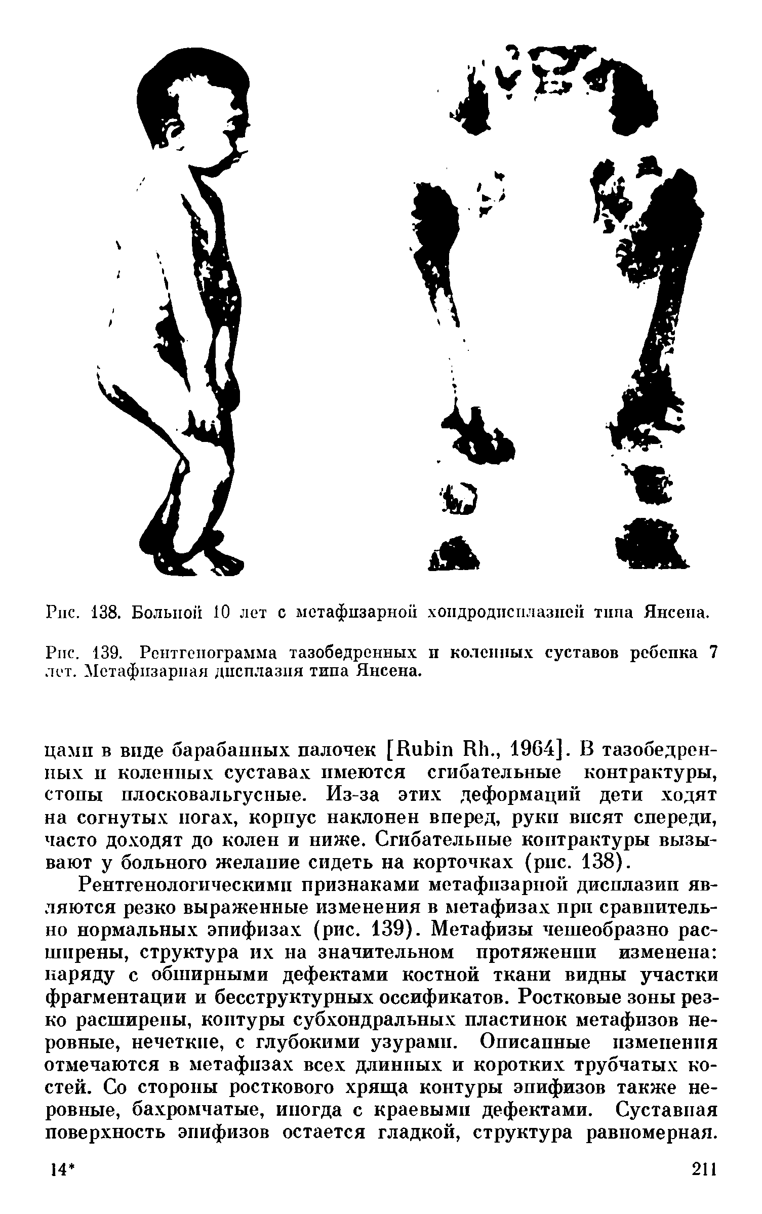 Рис. 139. Рентгенограмма тазобедренных и коленных суставов ребепка 7 лет. Мстафизарпая дисплазия типа Янсена.