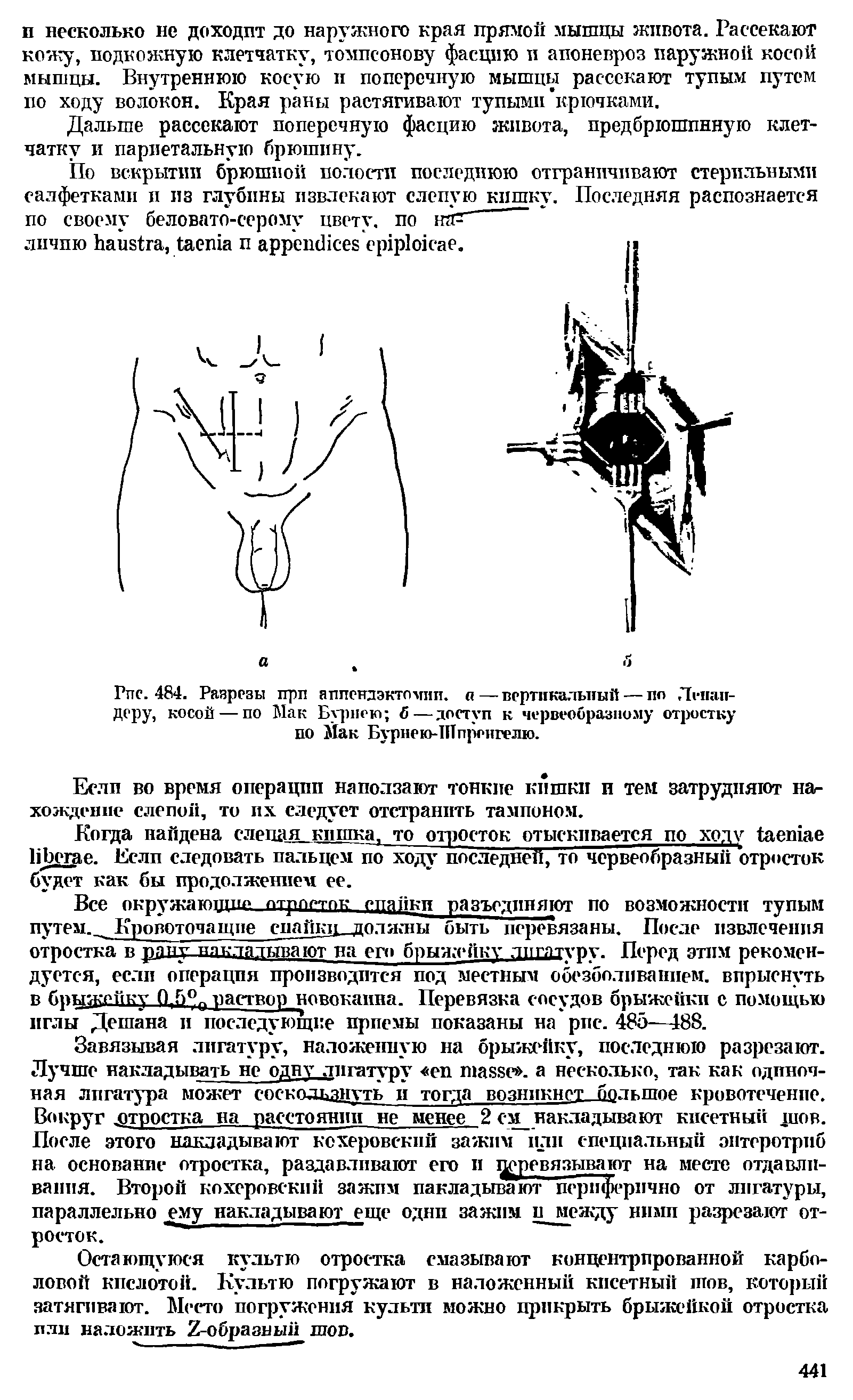 Рис. 484. Разрезы при аппендэктомии, а—вертикальный — по Лепап-деру, косой — по Мак Бурнею б — доступ к червеобразному отростку по Мак Бурнею-ПТпреигелю.