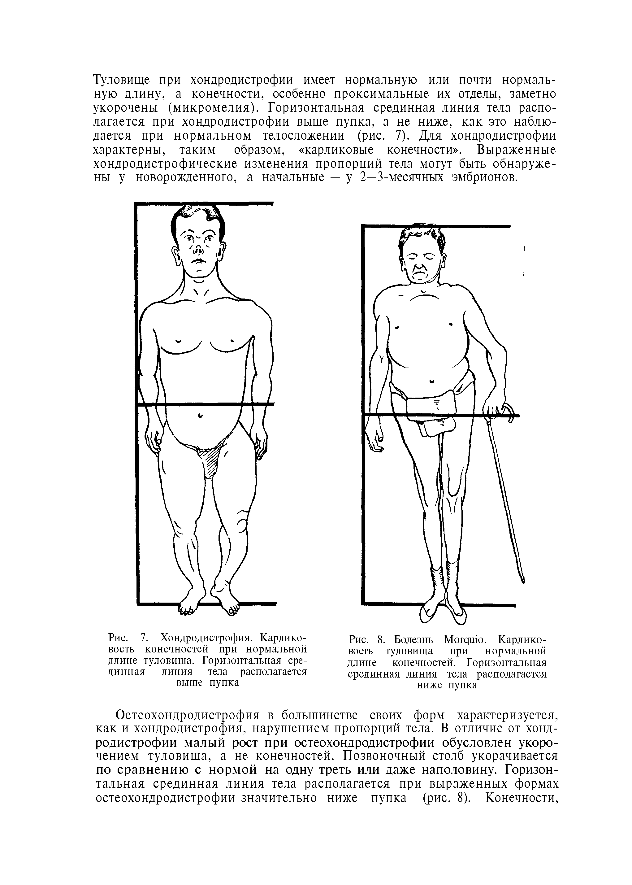 Рис. 7. Хондродистрофия. Карликовость конечностей при нормальной длине туловища. Горизонтальная срединная линия тела располагается выше пупка...