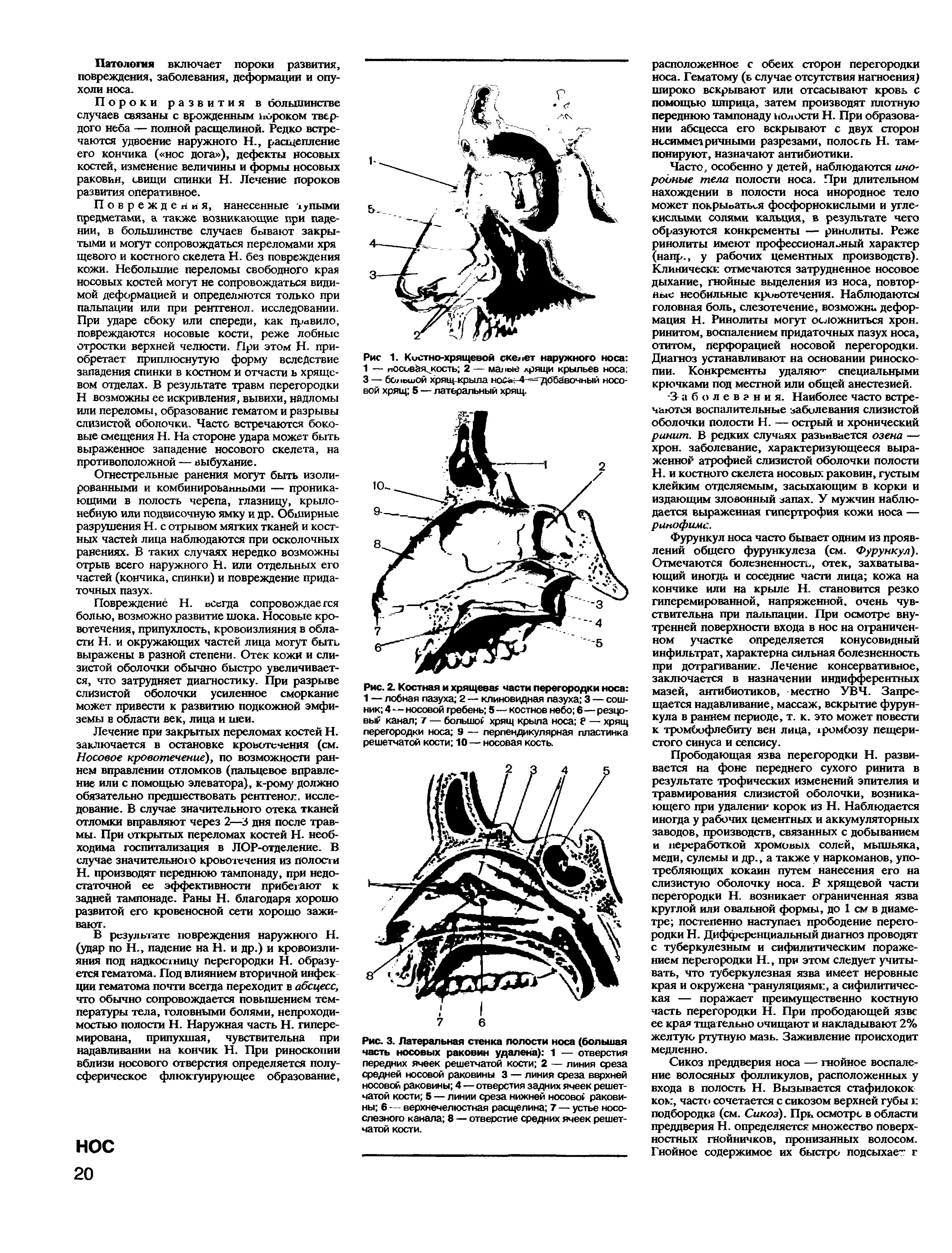 Рис. 2. Костная и хрящеват части перегородки носа 1 — лобная пазуха 2 — клиновидная пазуха 3 — сошник 4—носовой гребень 5—костное небо 6—резцовый канал 7 — большой хрящ крыла носа — хрящ перегородки носа 9 — перпендикулярная пластинка решетчатой кости 10 — носовая кость.