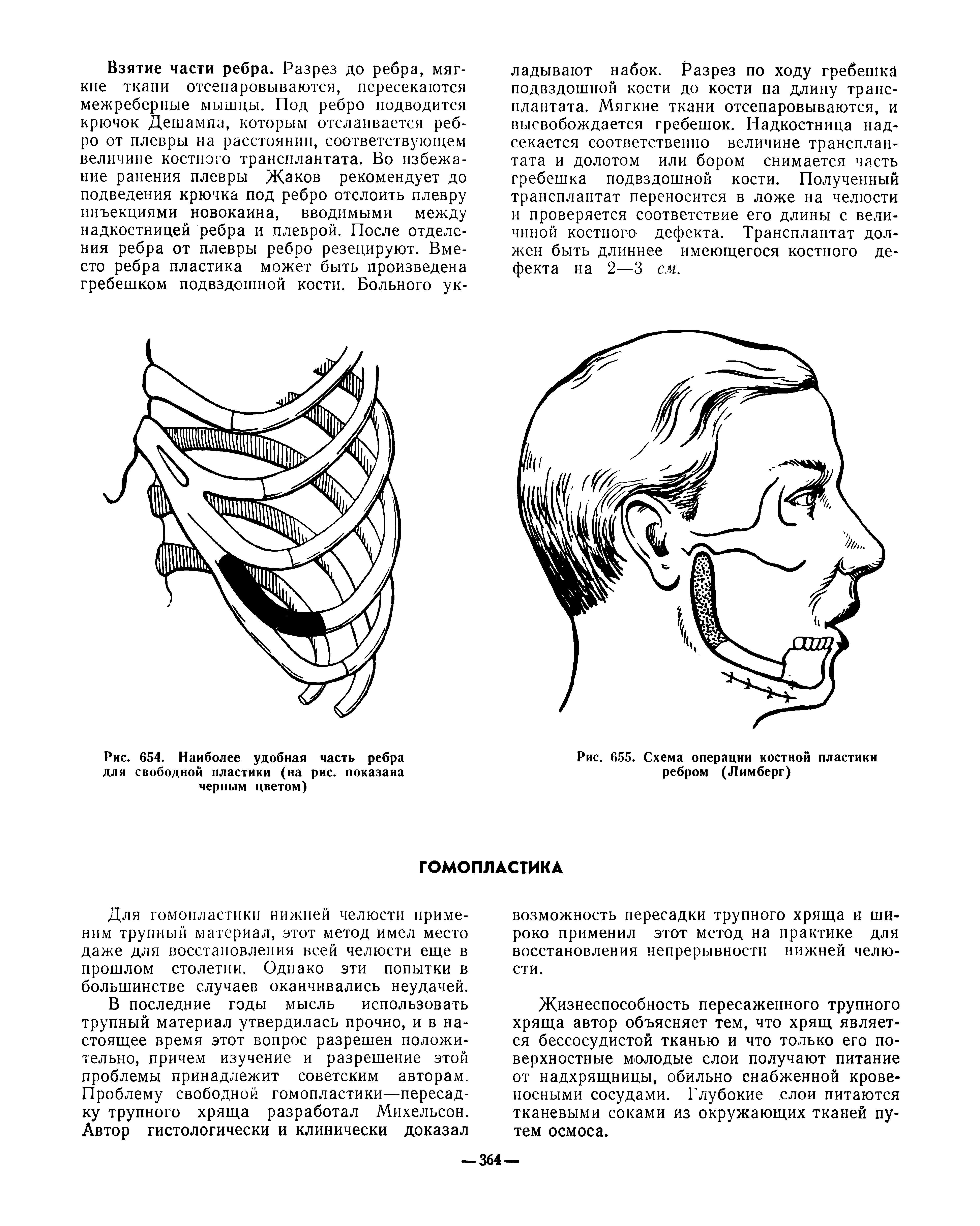 Рис. 655. Схема операции костной пластики ребром (Лимберг)...