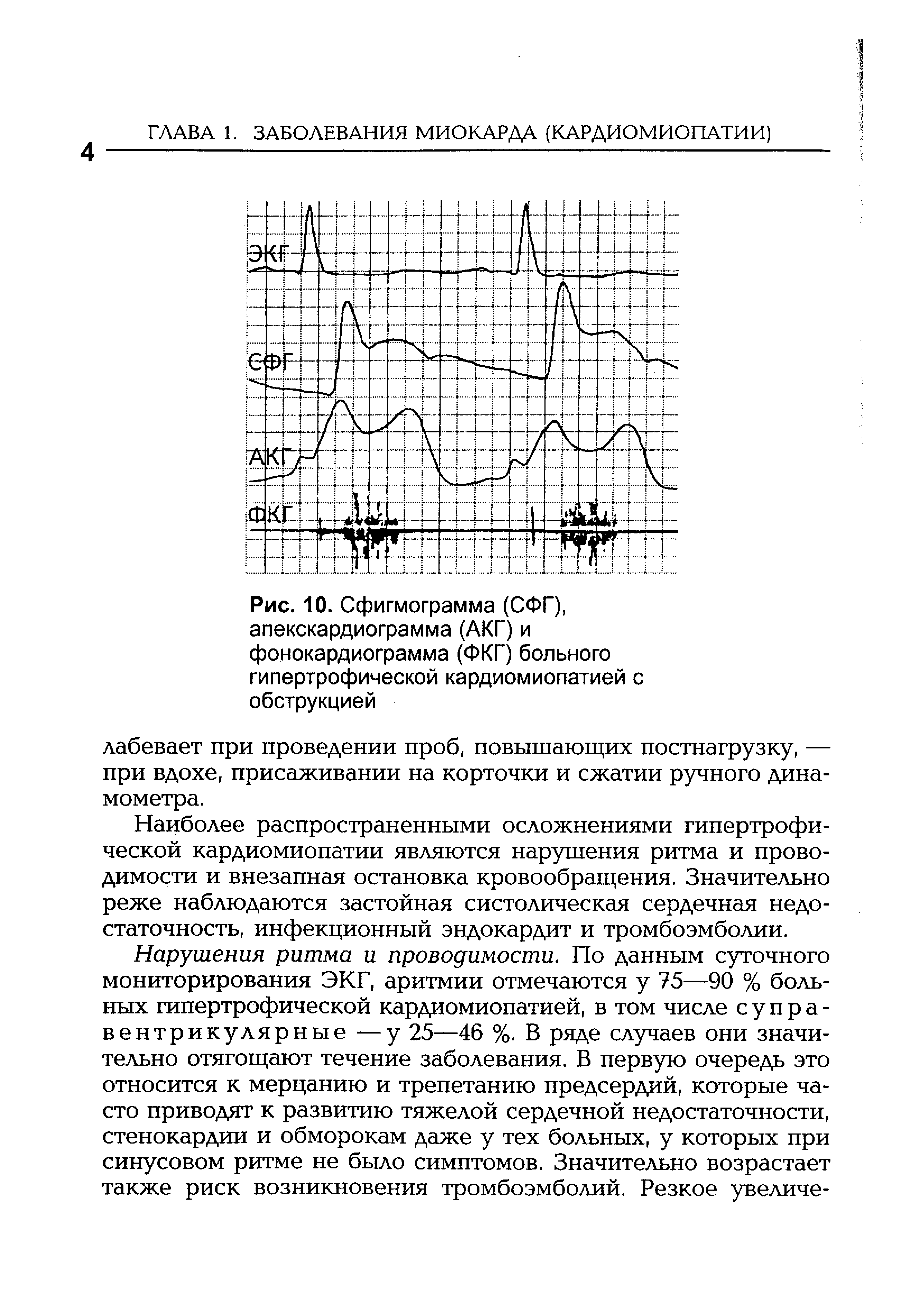 Рис. 10. Сфигмограмма (СФГ), апекскардиограмма (АКГ) и фонокардиограмма (ФКГ) больного гипертрофической кардиомиопатией с обструкцией...