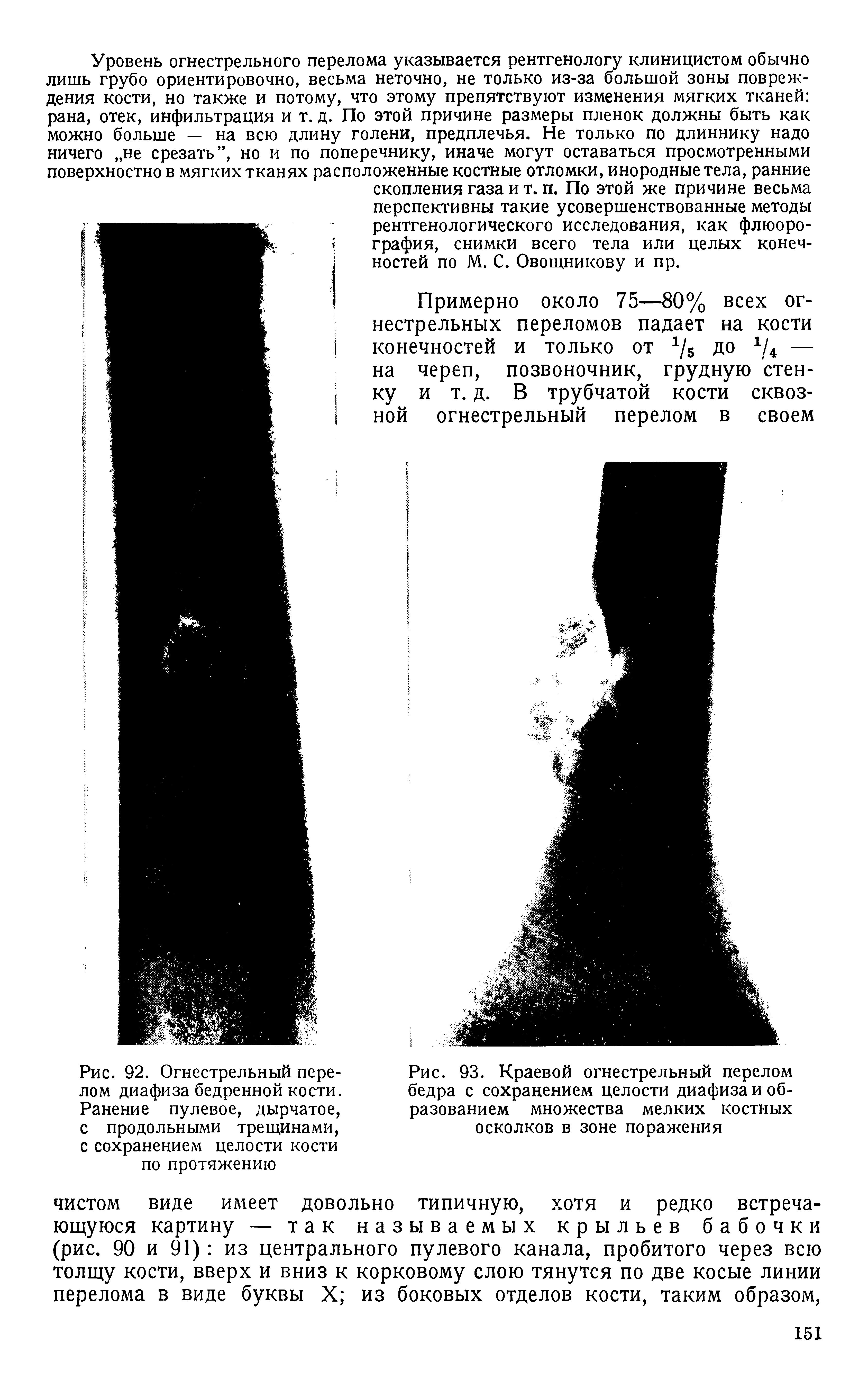 Рис. 93. Краевой огнестрельный перелом бедра с сохранением целости диафиза и образованием множества мелких костных осколков в зоне поражения...