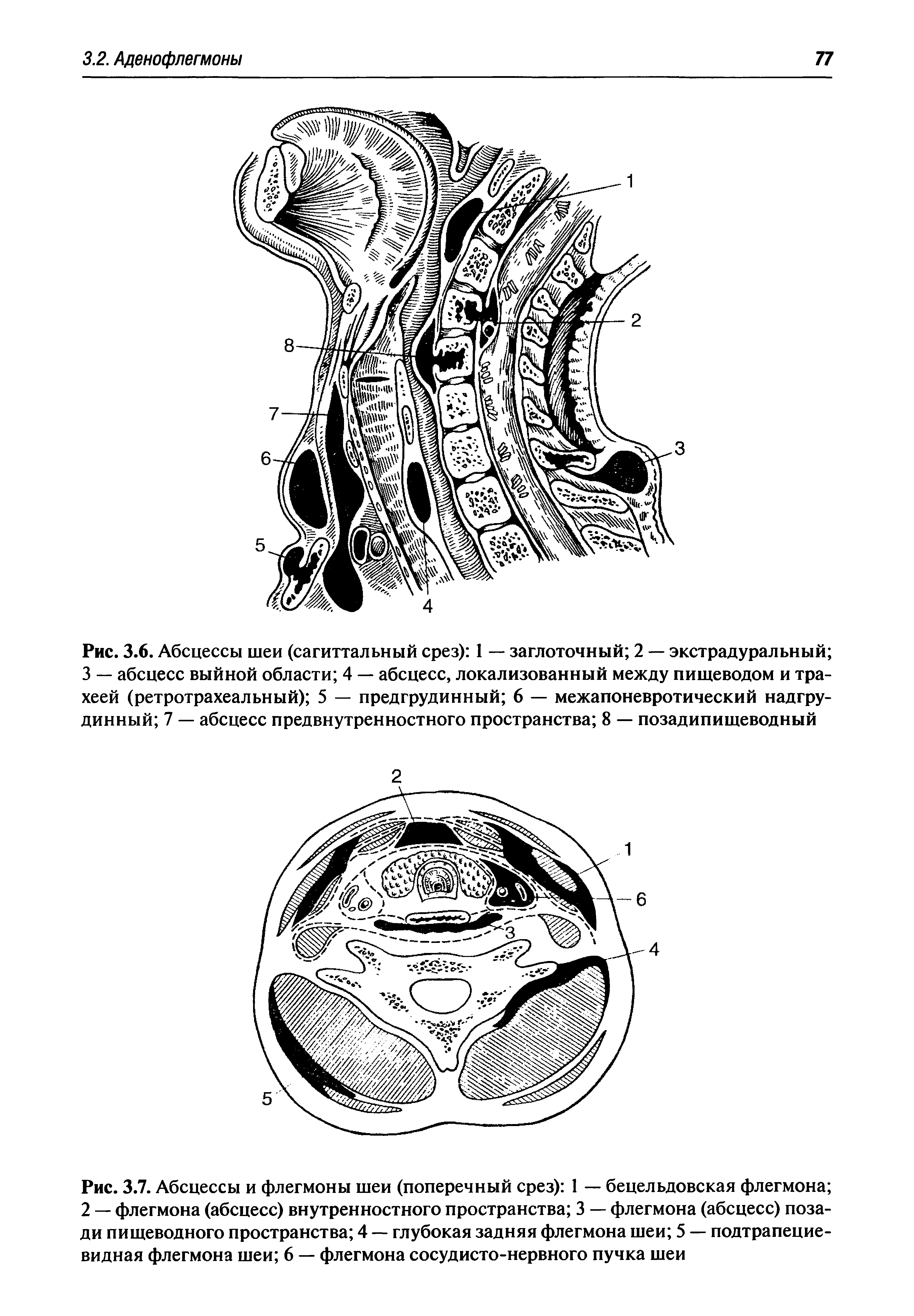 Рис. 3.7. Абсцессы и флегмоны шеи (поперечный срез) 1 — бецельдовская флегмона 2 — флегмона (абсцесс) внутренностного пространства 3 — флегмона (абсцесс) позади пищеводного пространства 4 — глубокая задняя флегмона шеи 5 — подтрапециевидная флегмона шеи 6 — флегмона сосудисто-нервного пучка шеи...