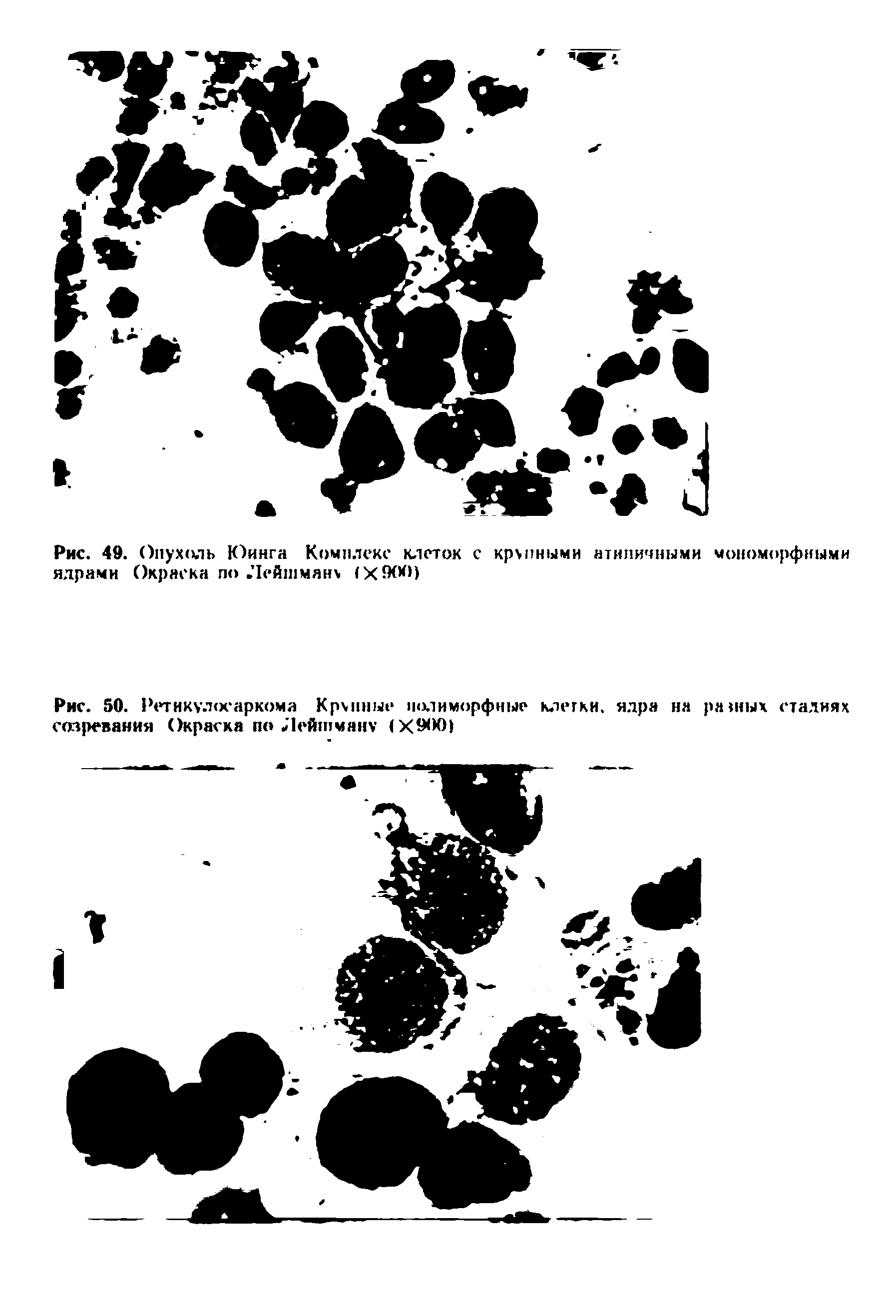 Рис. 50. Ретику.кх аркома Крупные полиморфные клетки, ядра на ратных стадиях созревания Окраска по Лейшману (ХМЮ)...