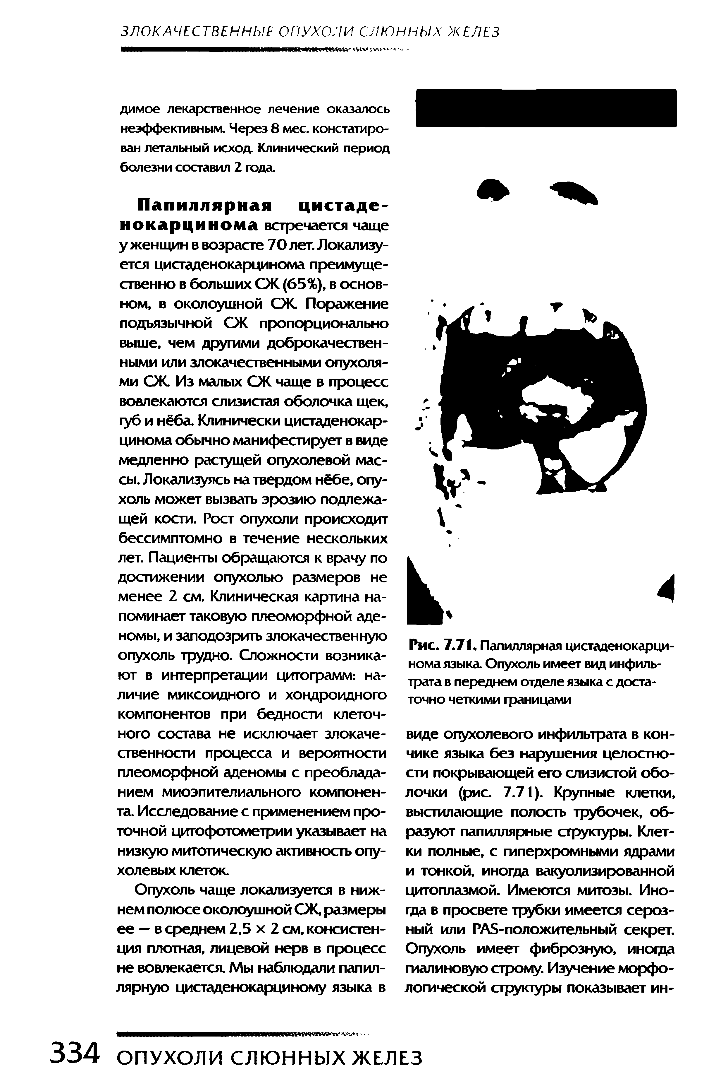 Рис. 7.71. Папиллярная цистаденокарцинома языка. Опухоль имеет вид инфильтрата в переднем отделе языка с достаточно четкими границами...