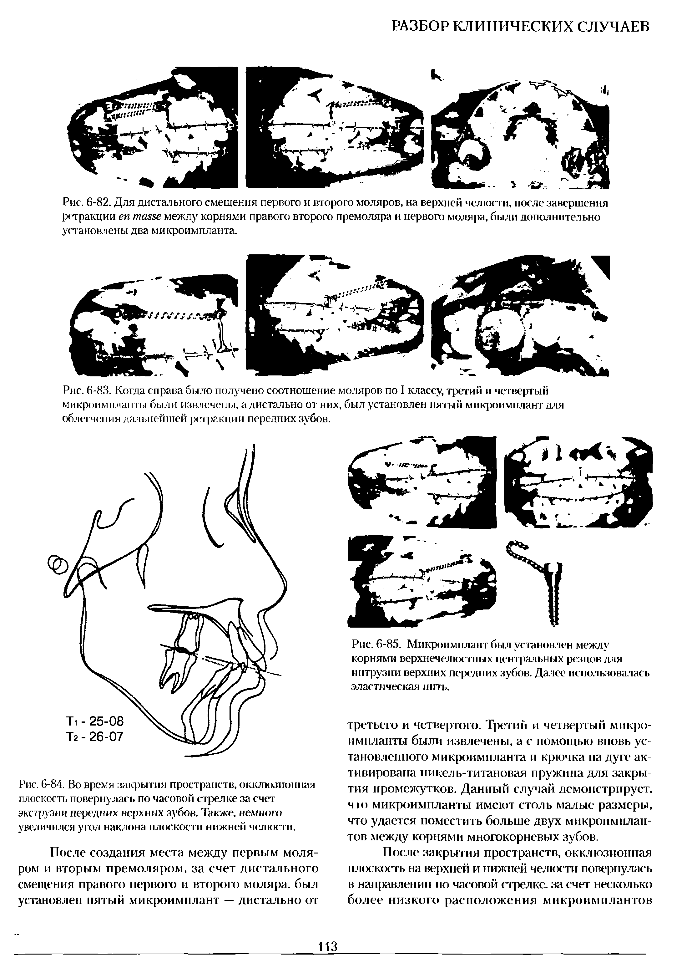 Рис. 6-85. Микроимнлант был установлен между корнями верхнечелюстных центральных резцов для интрузии верхних передних зубов. Далее использовалась эластическая нить.