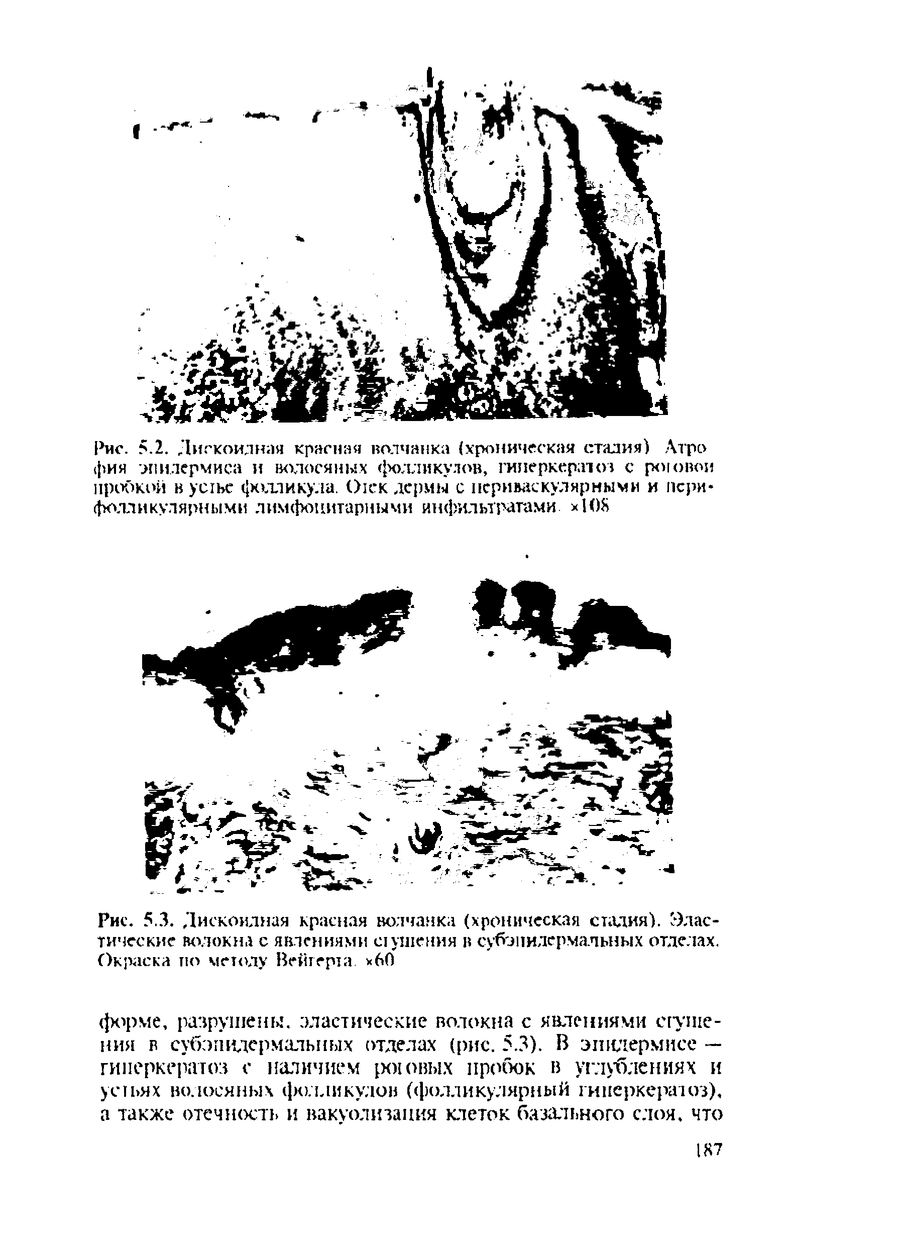 Рис. 5.3. Дискоидная красная волчанка (хроническая стадия). Эластические волокна с явлениями шушения в субэпидермальных отделах. Окраска по метолу Вейгерта. 60...