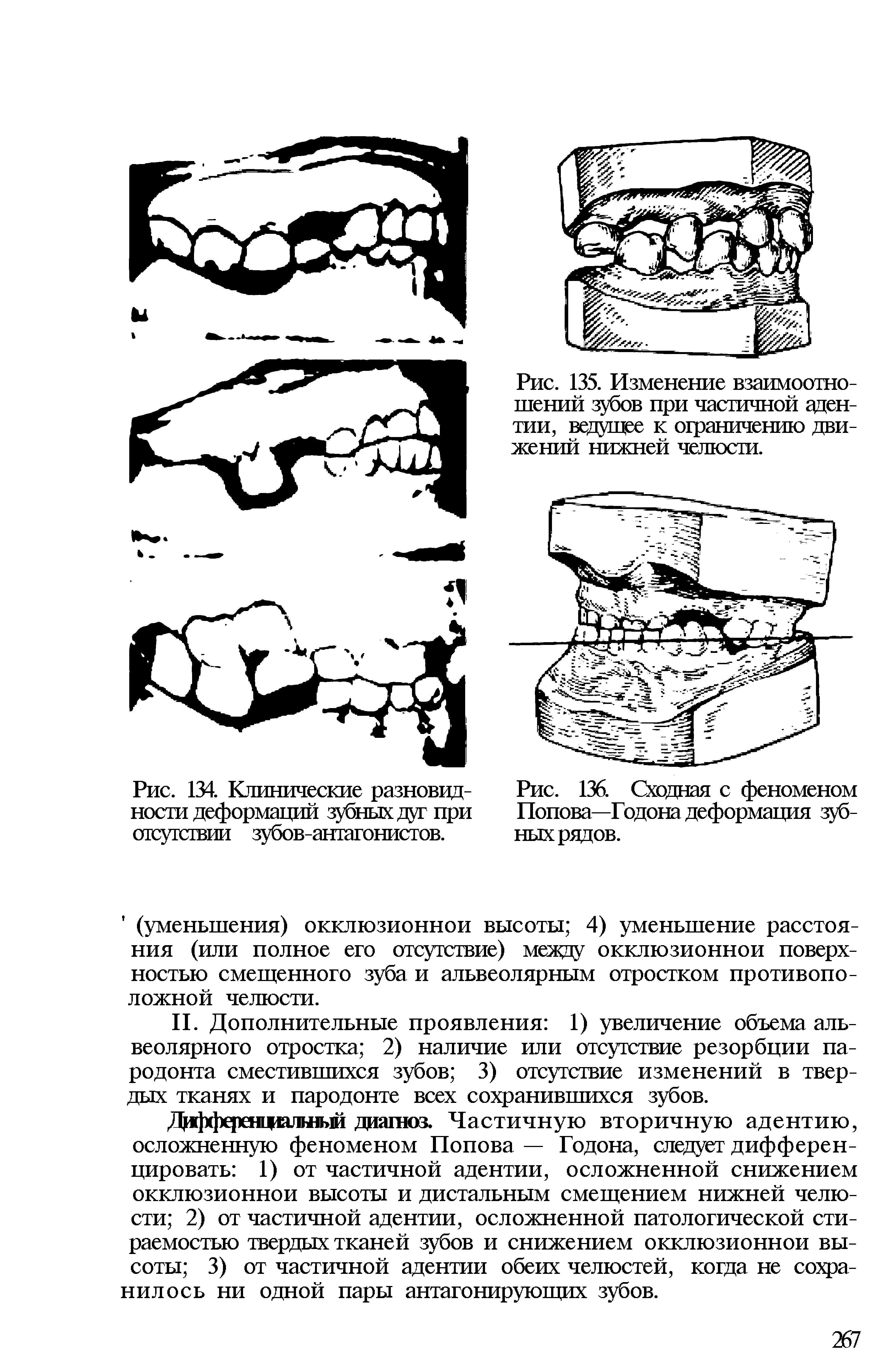 Рис. 136. Сходная с феноменом Попова—Годона деформация зубных рядов.