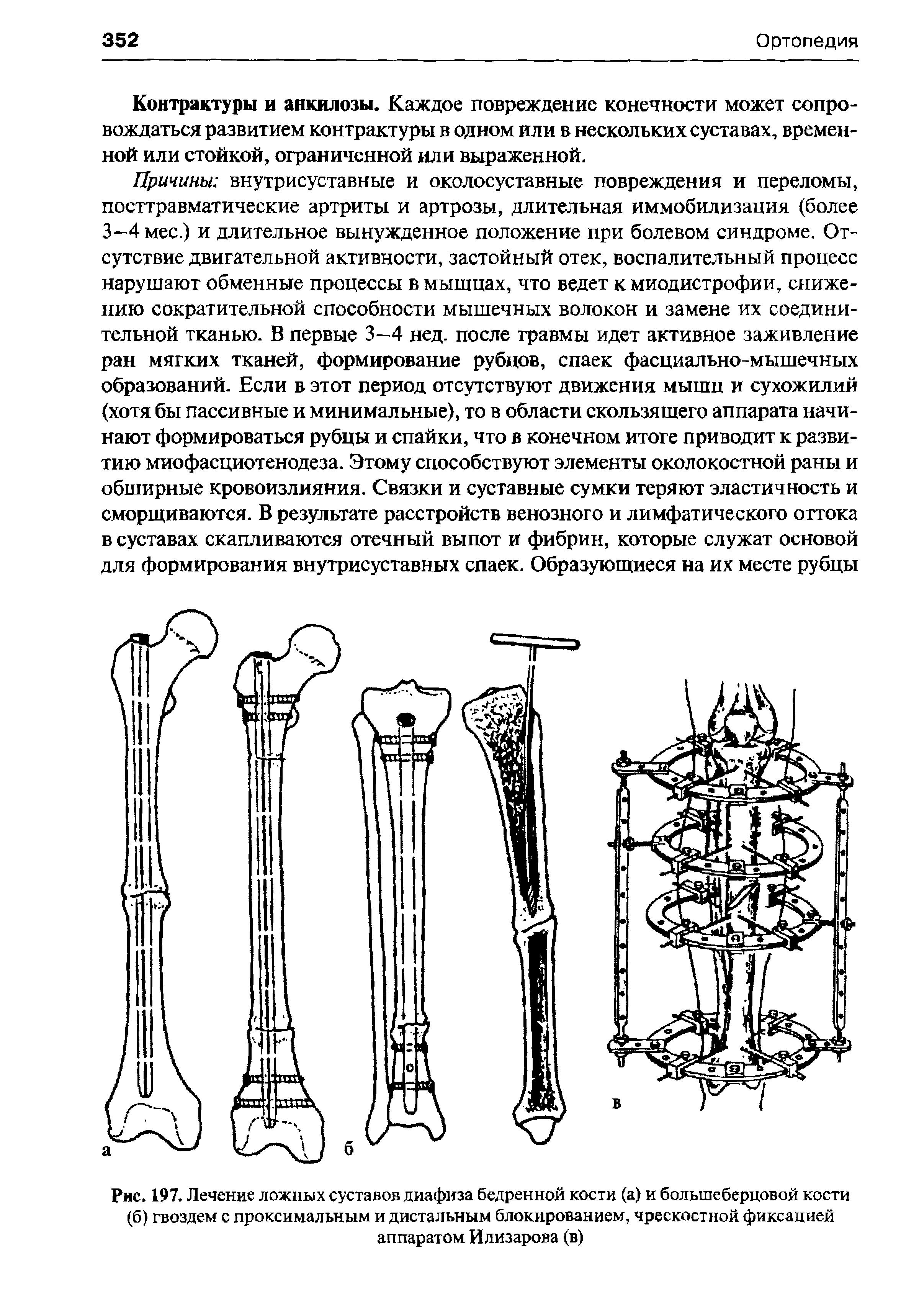 Рис. 197. Лечение ложных суставов диафиза бедренной кости (а) и большеберцовой кости (6) гвоздем с проксимальным и дистальным блокированием, чрескостной фиксацией аппаратом Илизарова (в)...