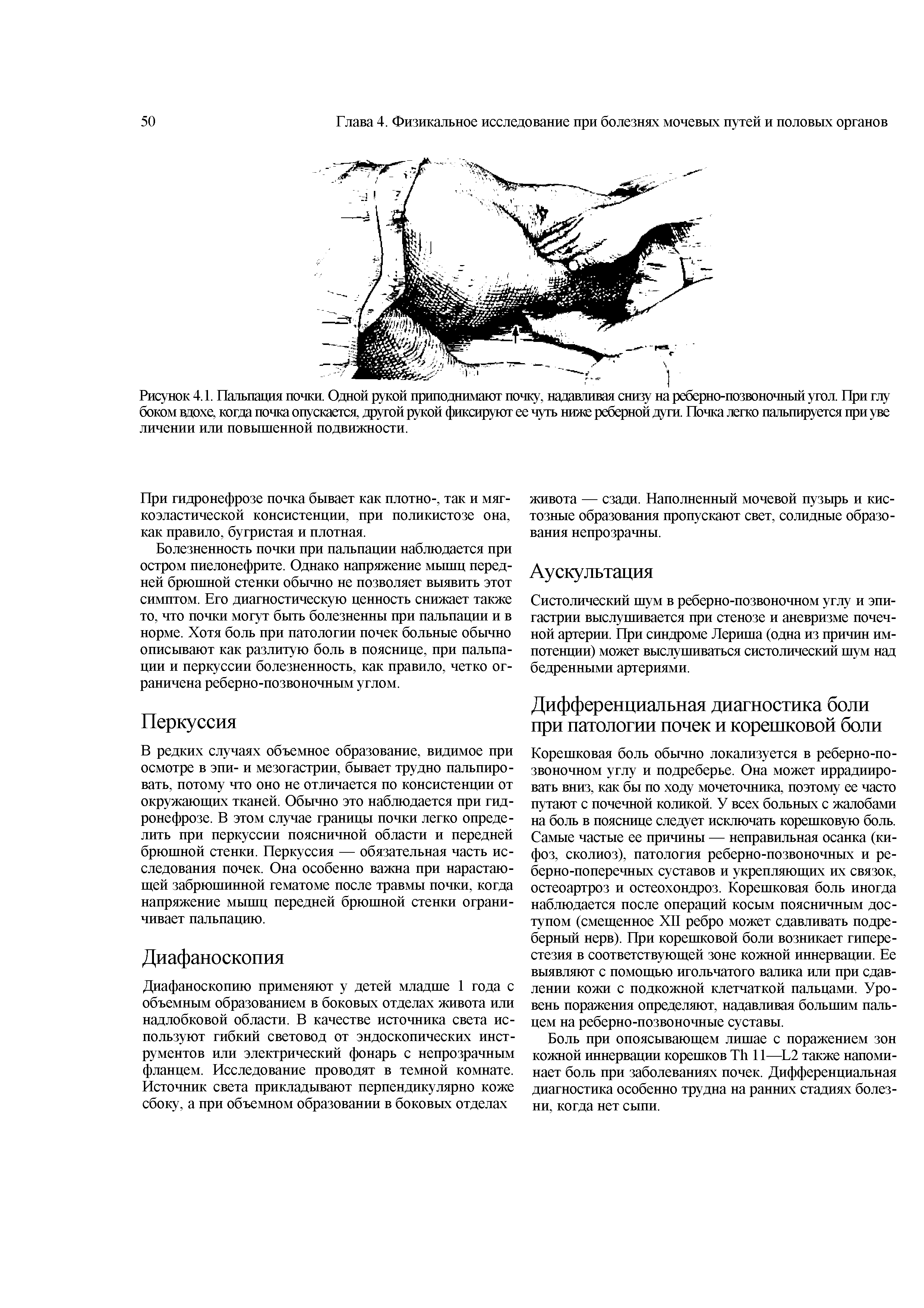 Рисунок 4.1. Пальпация почки. Одной рукой приподнимают почку, надавливая снизу на реберно-позвоночный угол. При глу боком вдохе, когда почка опускается, другой рукой фиксируют ее чуть ниже реберной дуги. Почка легко пальпируется при уве личении или повышенной подвижности.