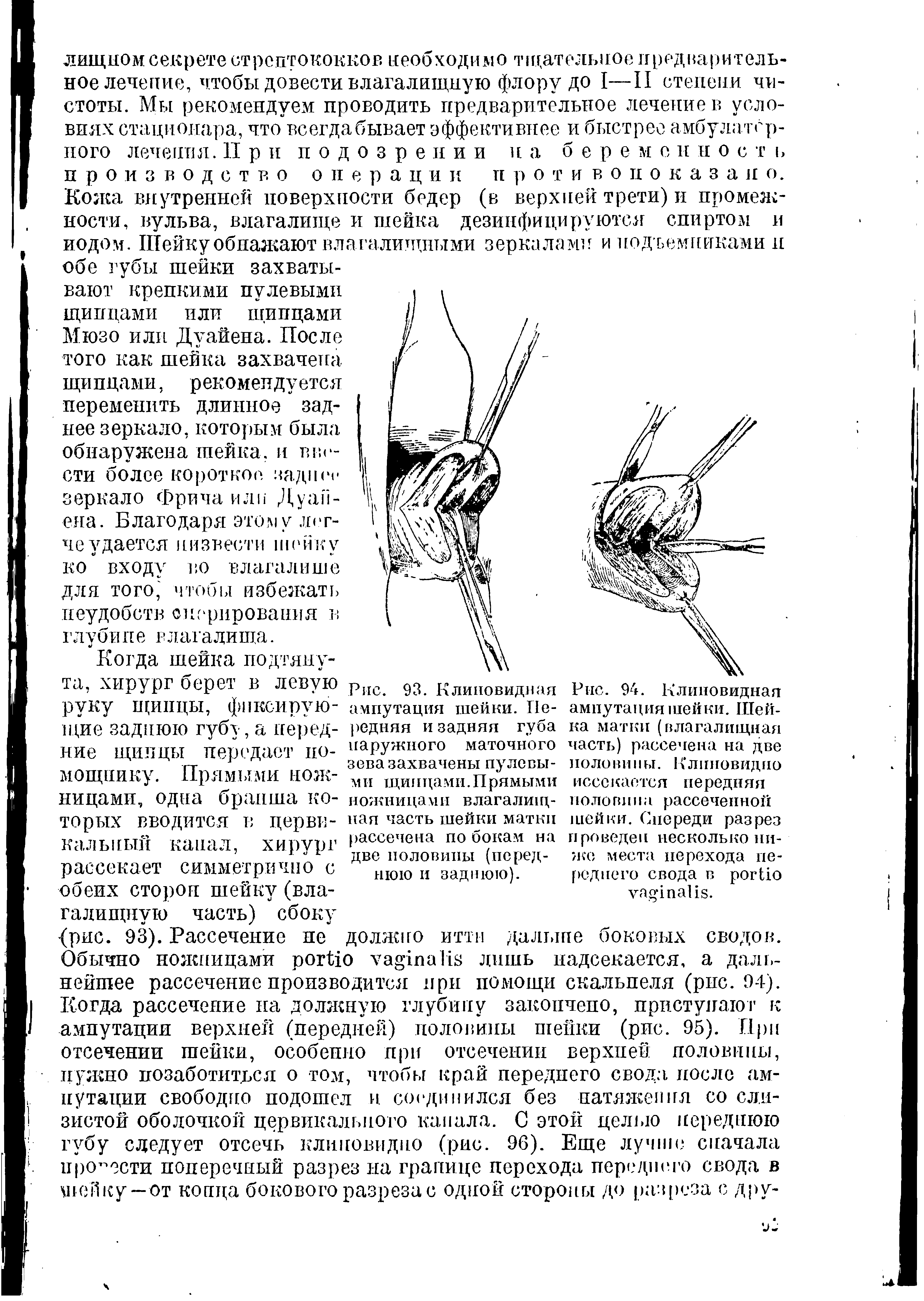 Рис. 94. Клиновидная ампутация шейки. Шейка матки (влагалищная часть) рассечена на две половины. Клиновидно иссекается передняя половина рассеченной шейки. Спереди разрез проведен несколько ниже места перехода переднего свода в .