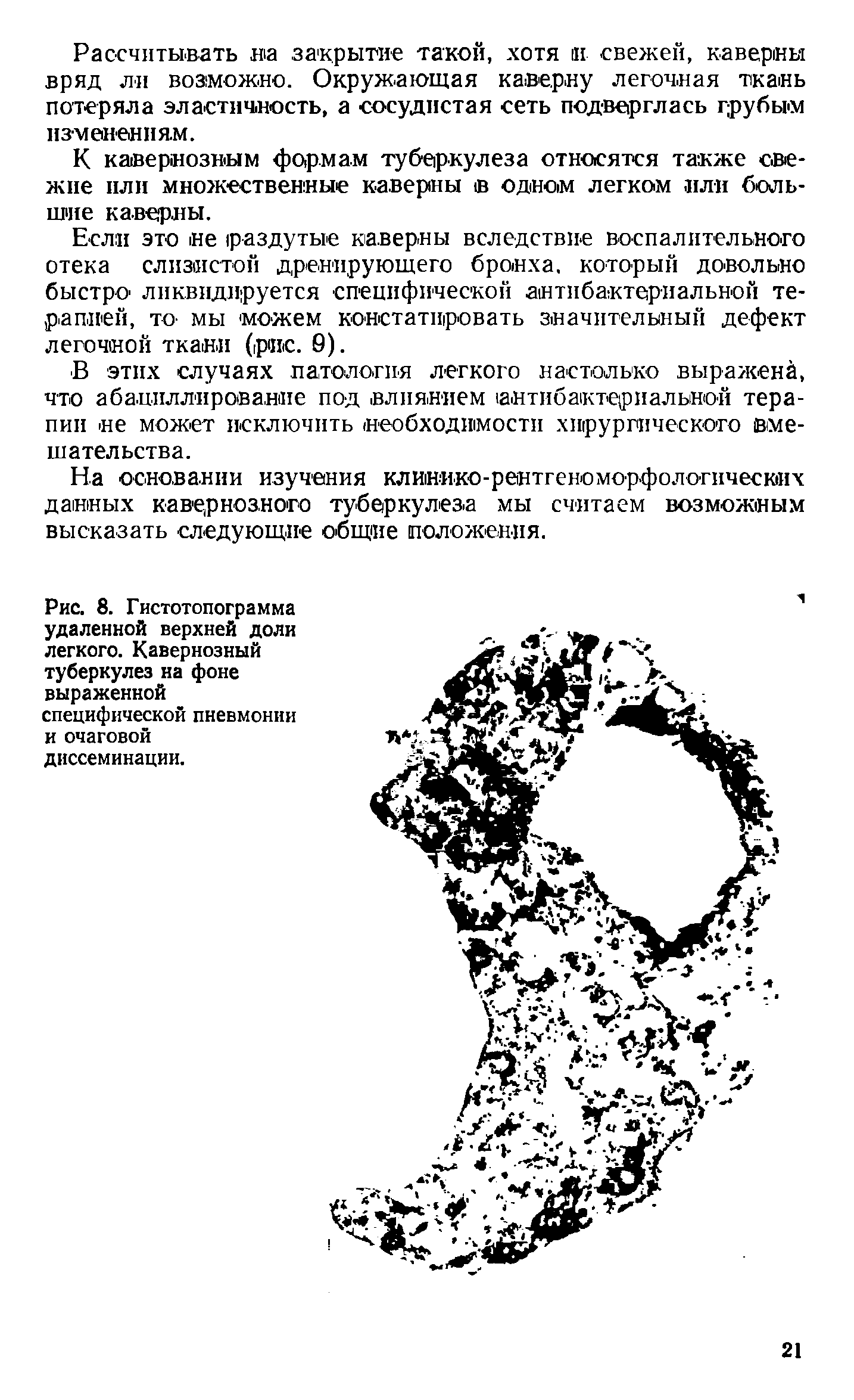 Рис. 8. Гистотопограмма удаленной верхней доли легкого. Кавернозный туберкулез на фоне выраженной специфической пневмонии и очаговой диссеминации.