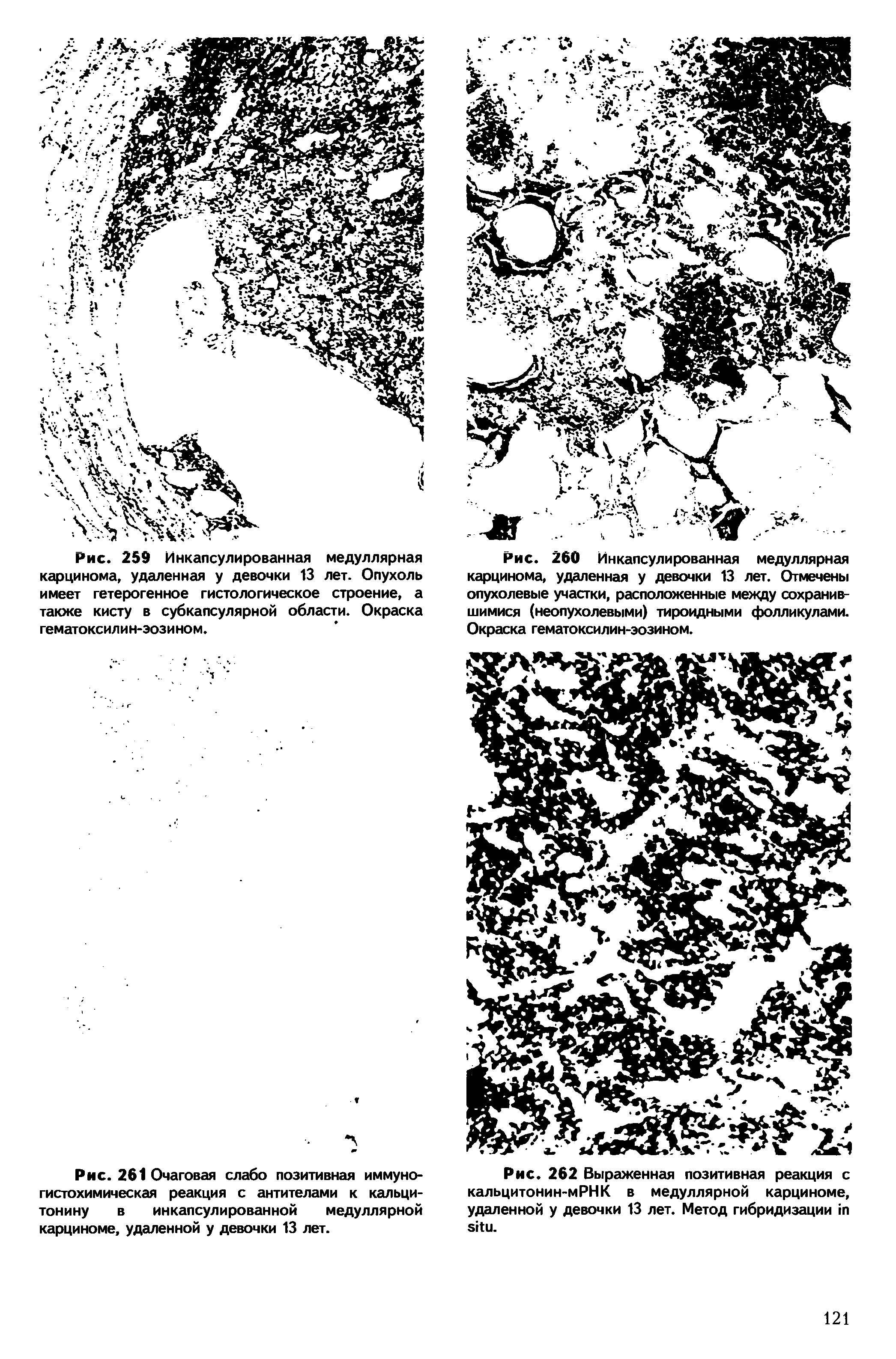 Рис. 260 Инкапсулированная медуллярная карцинома, удаленная у девочки 13 лет. Отмечены опухолевые участки, расположенные между сохранившимися (неопухолевыми) тироидными фолликулами. Окраска гематоксилин-эозином.