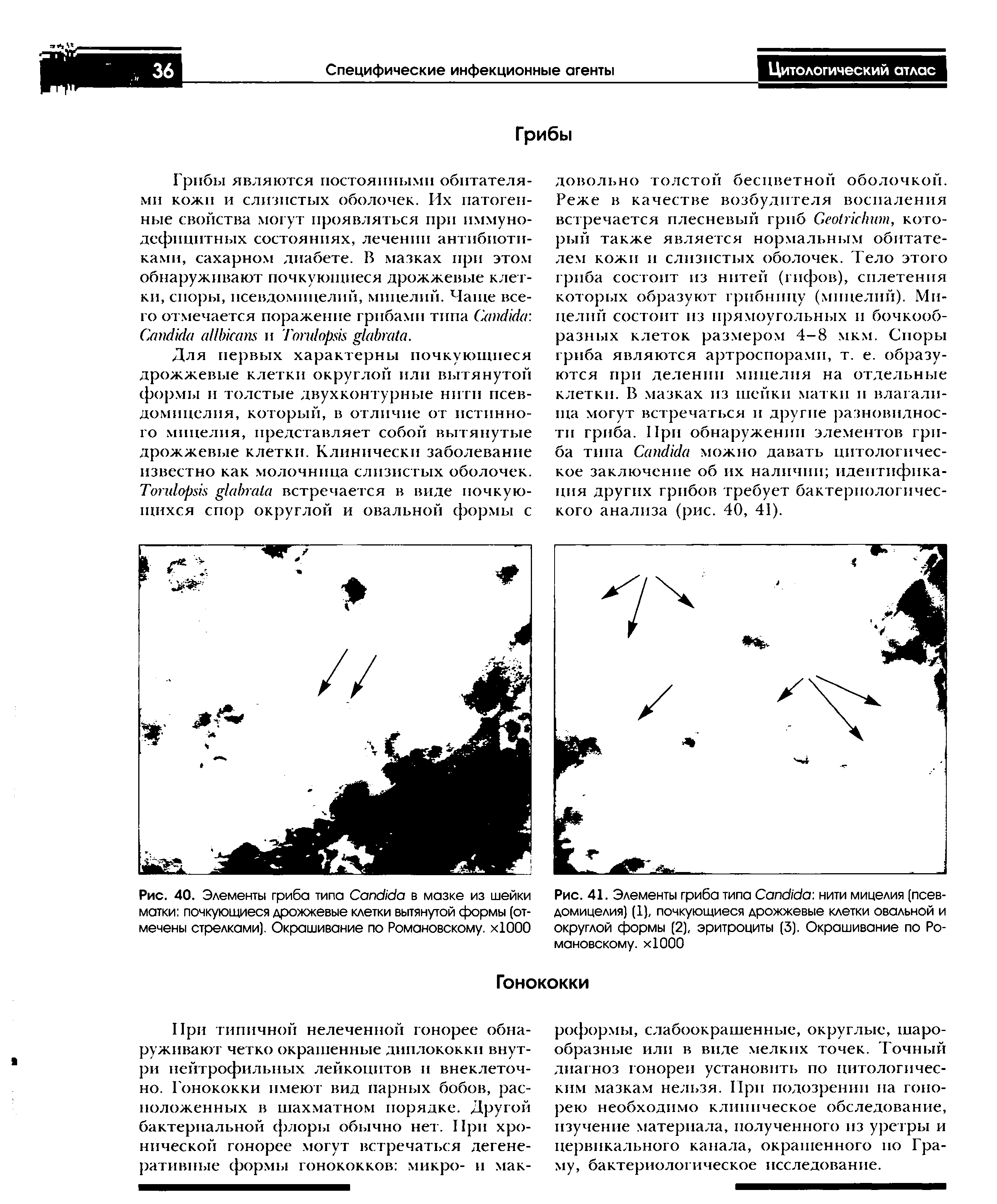 Рис. 41. Элементы гриба типа C нити мицелия (псевдомицелия) (1), почкующиеся дрожжевые клетки овальной и округлой формы (2), эритроциты (3). Окрашивание по Романовскому. хЮОО...