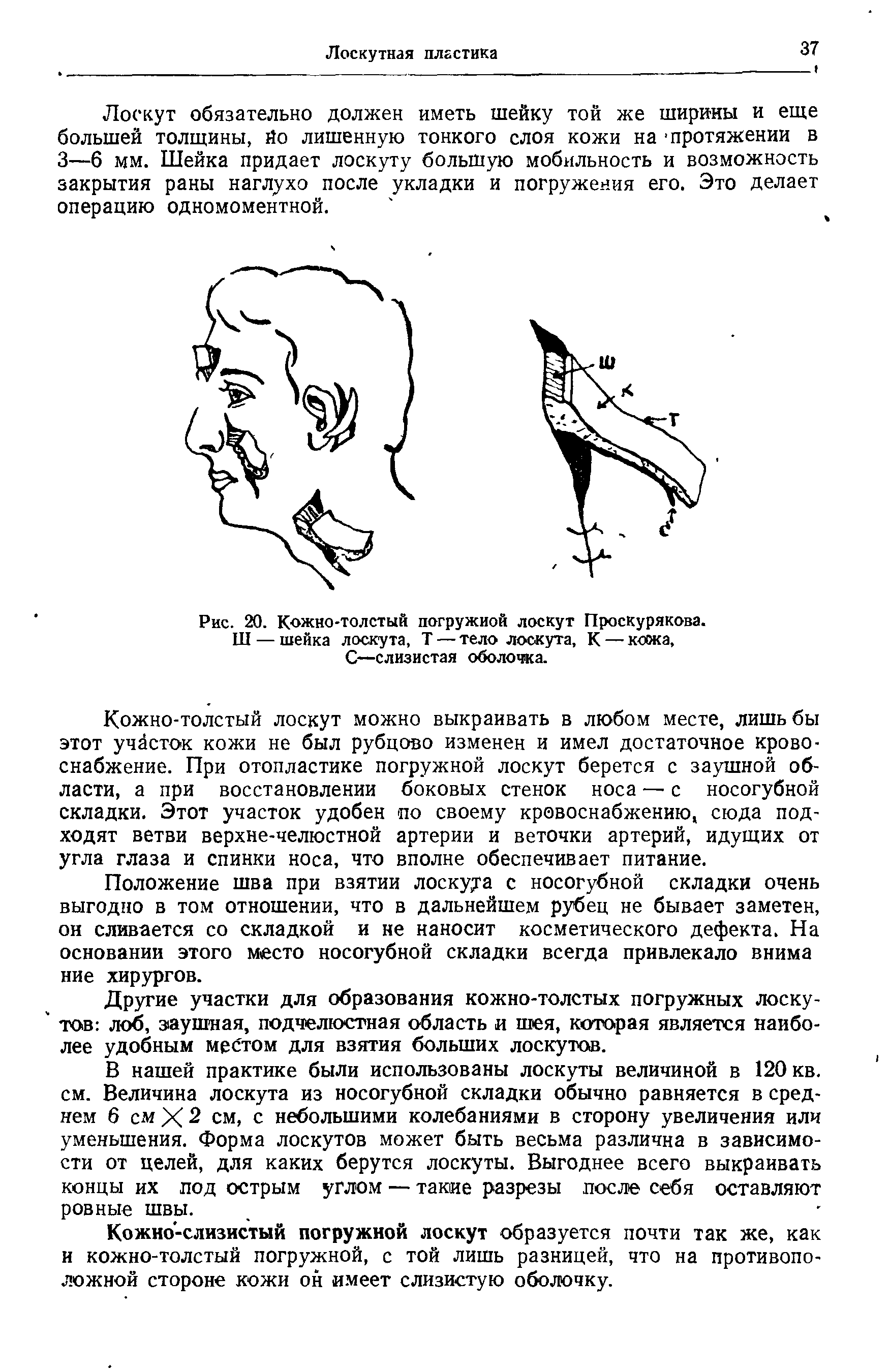 Рис. 20. Кожно-толстый погружной лоскут Проскурякова. Ш — шейка лоскута, Т — тело лоскута, К — кожа, С—слизистая оболочка.