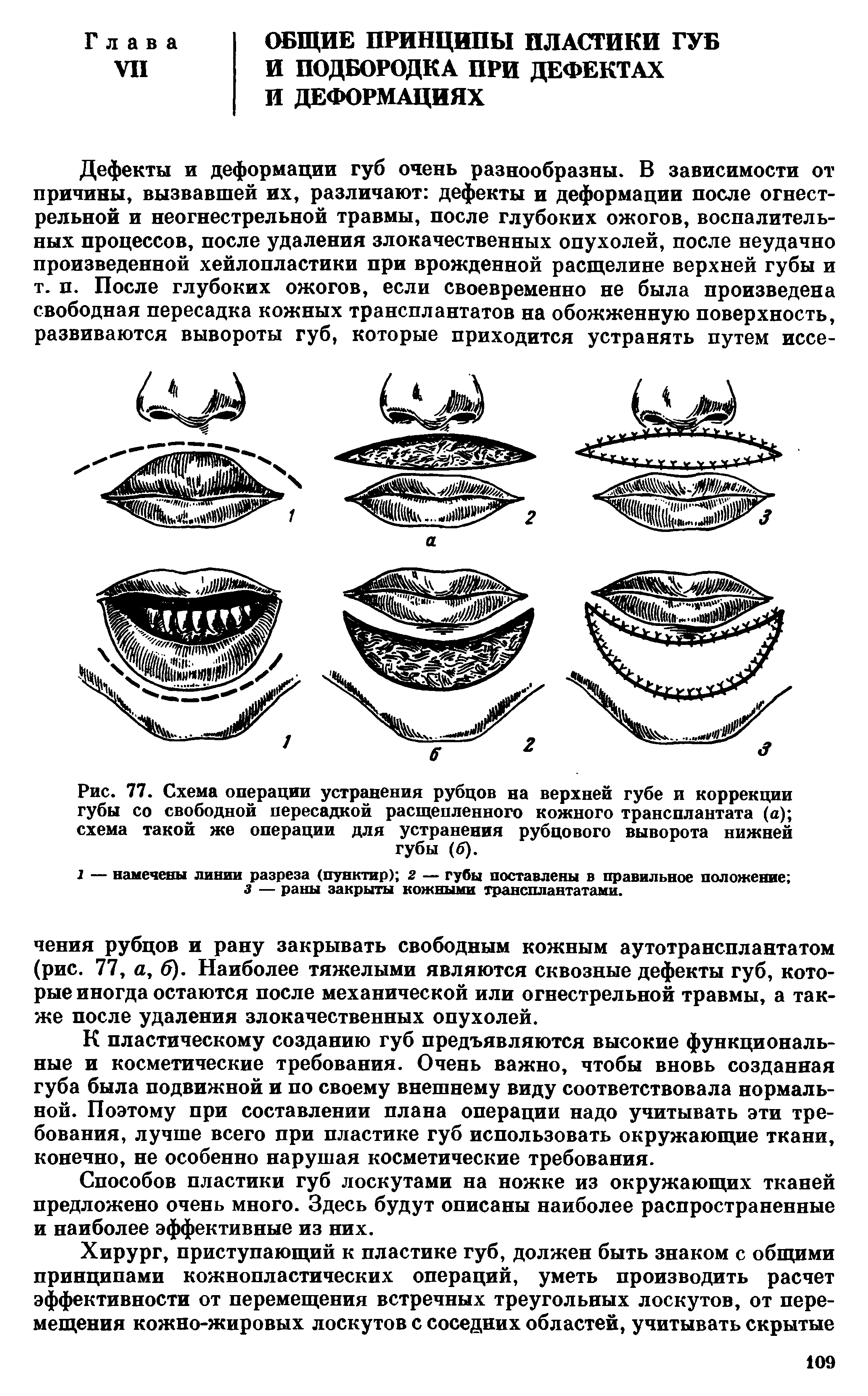 Рис. 77. Схема операции устранения рубцов на верхней губе и коррекции губы со свободной пересадкой расщепленного кожного трансплантата (а) схема такой же операции для устранения рубцового выворота нижней губы (б).