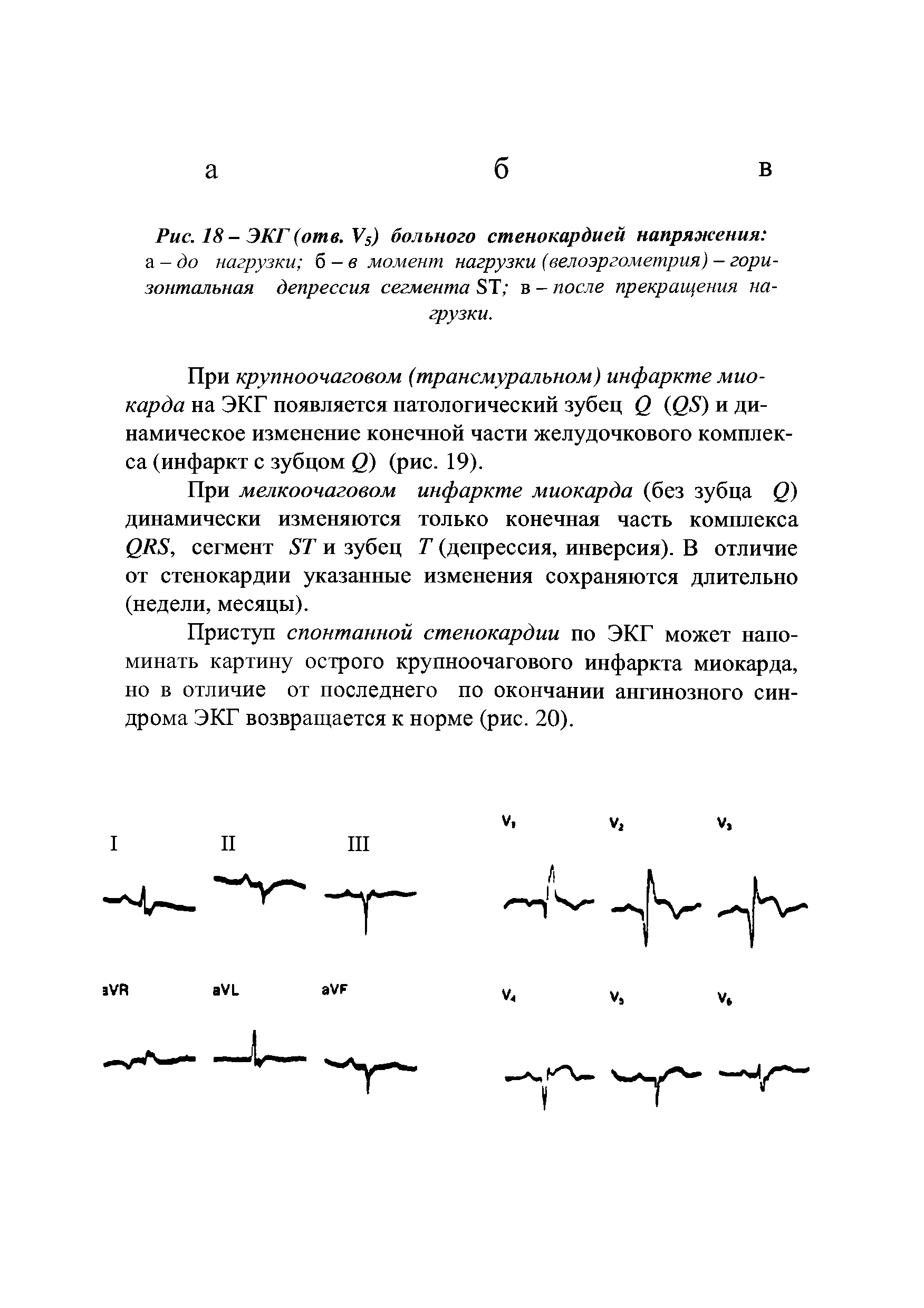 Рис. 18-ЭКГ(отв. У5) больного стенокардией напряжения а-до нагрузки б - в момент нагрузки (велоэргометрия) — горизонтальная депрессия сегмента 8Т в - после прекращения нагрузки.